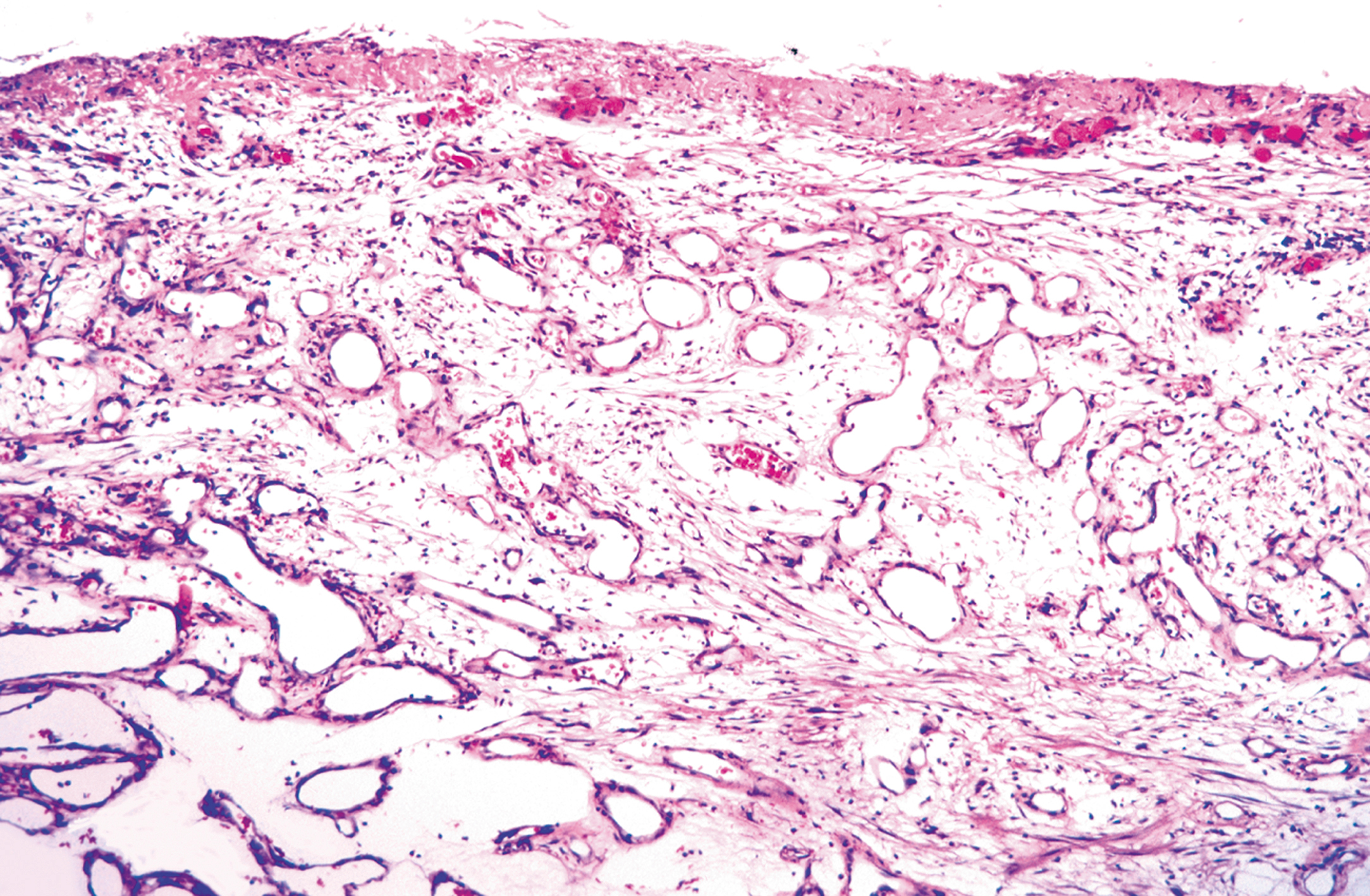 A histological section of pyogenic granuloma with stromal edema widely separating vascular channels beneath an ulcerated surface.