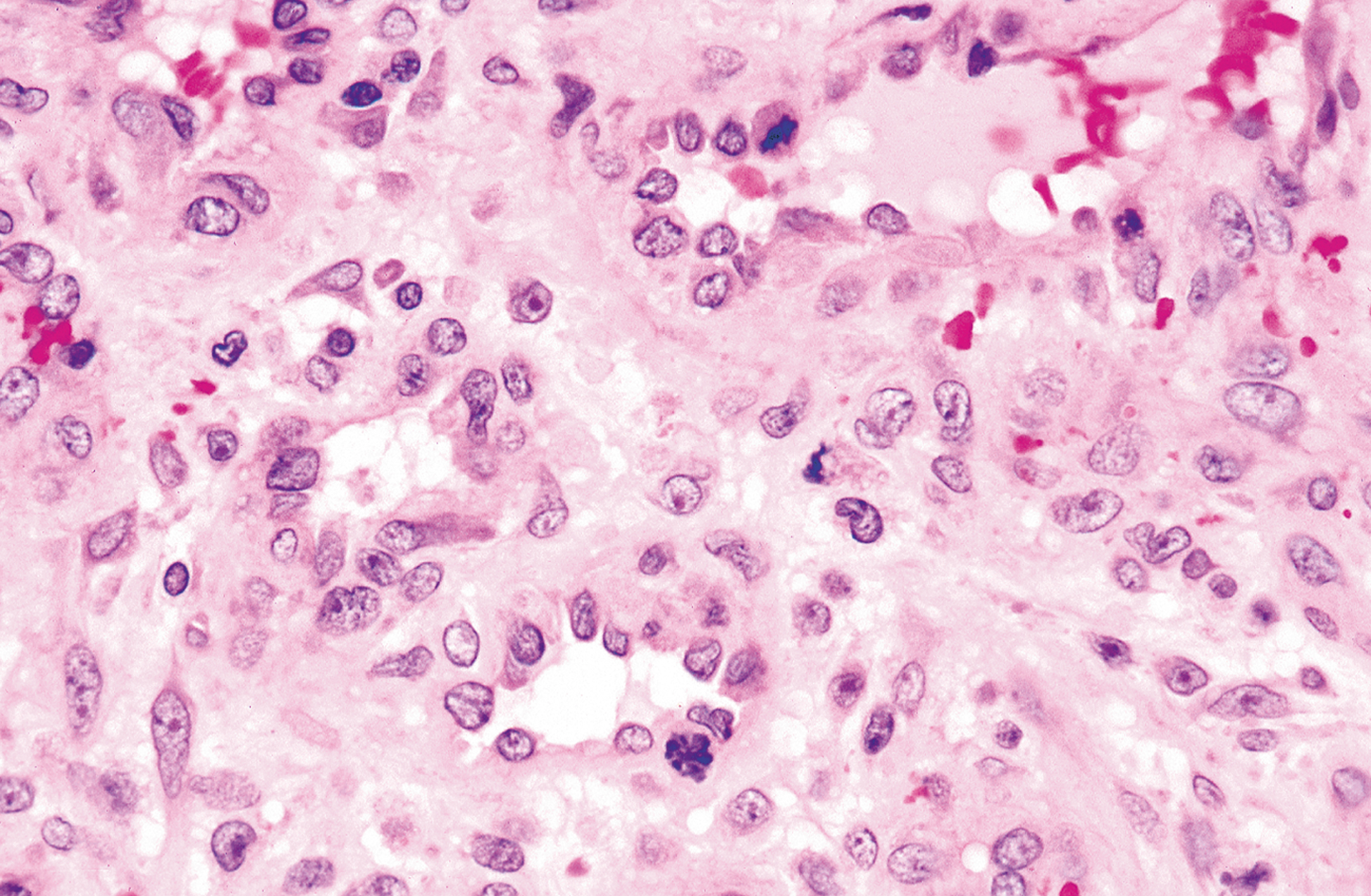 A high magnification view of pyogenic granuloma with mitotic figures in stromal and endothelial cells as part of reactive changes.