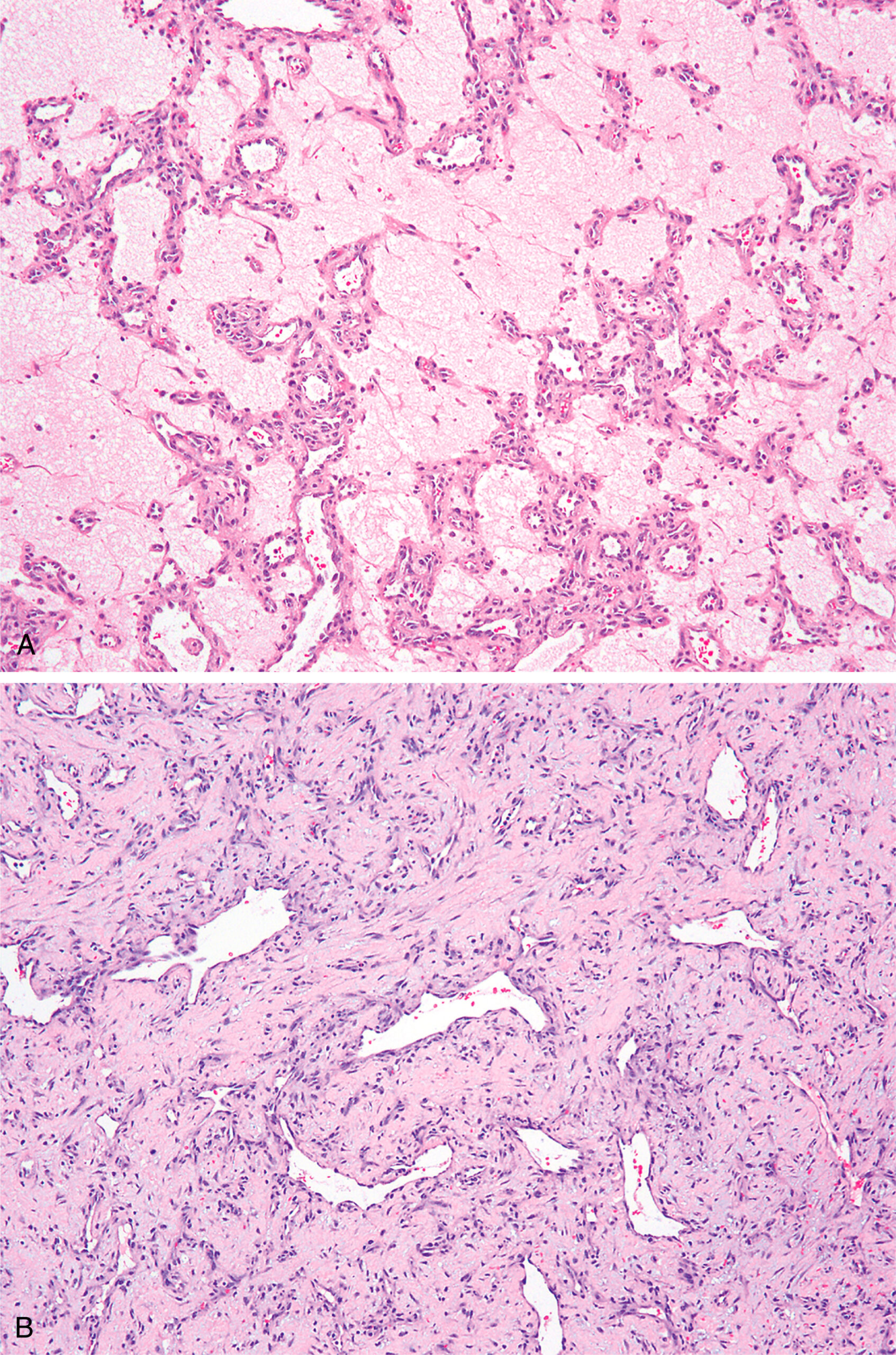 A set of two histological sections of intranasal pyogenic granuloma with extensive myxoid change in the upper view and stromal hyalinization in the lower view. The upper section shows intranasal pyogenic granuloma with extensive myxoid change, featuring a loose extracellular matrix separating small vessels and stromal cells, disrupting the lobular pattern. The lower section shows marked stromal hyalinization with dense, eosinophilic matrix surrounding vessels and elongated stromal cells, giving a compact appearance. Both retain the vascular features of pyogenic granuloma but differ in stromal texture.