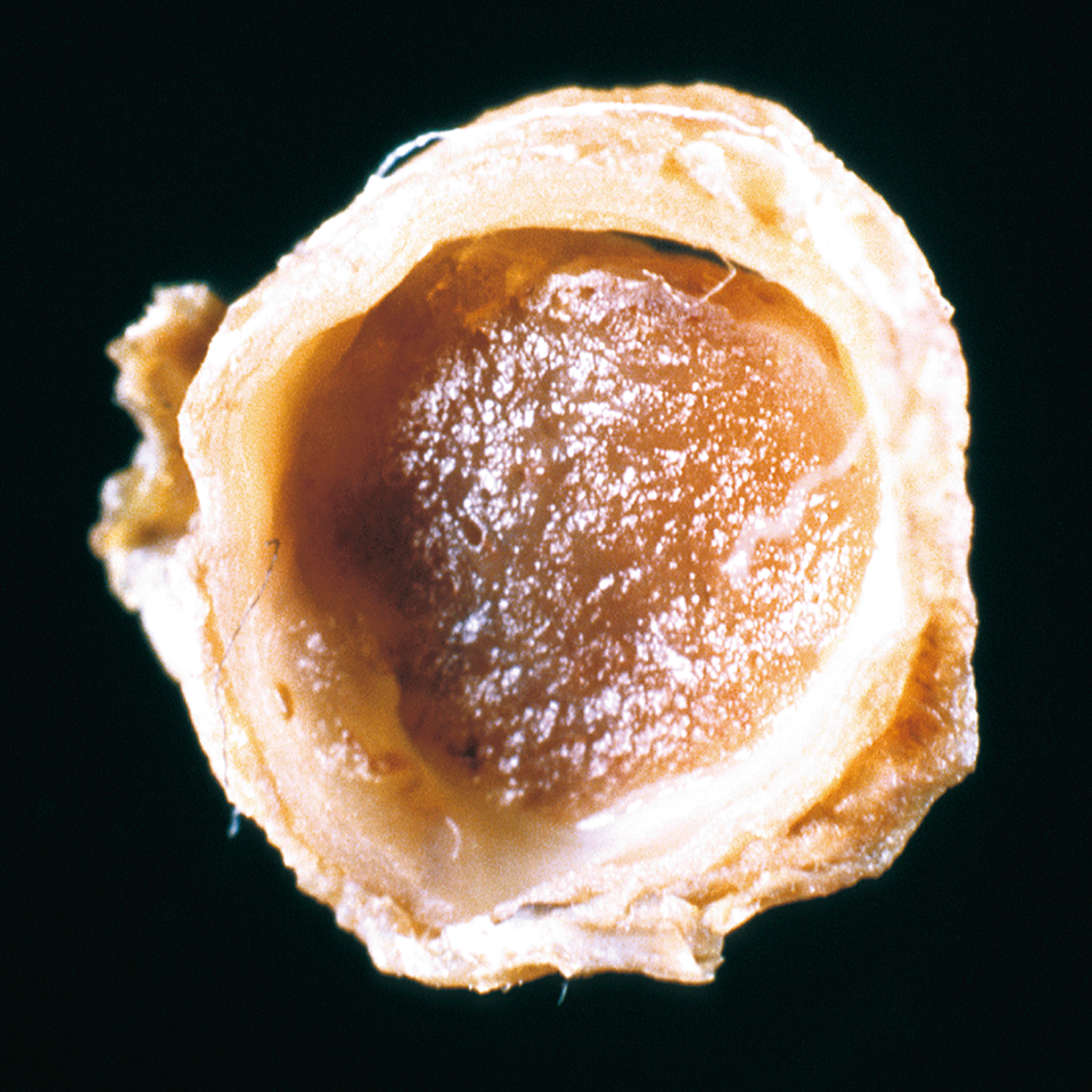 A gross circular specimen of the intravascular form of pyogenic granuloma with a centrally placed solid mass surrounded by a vascular wall.