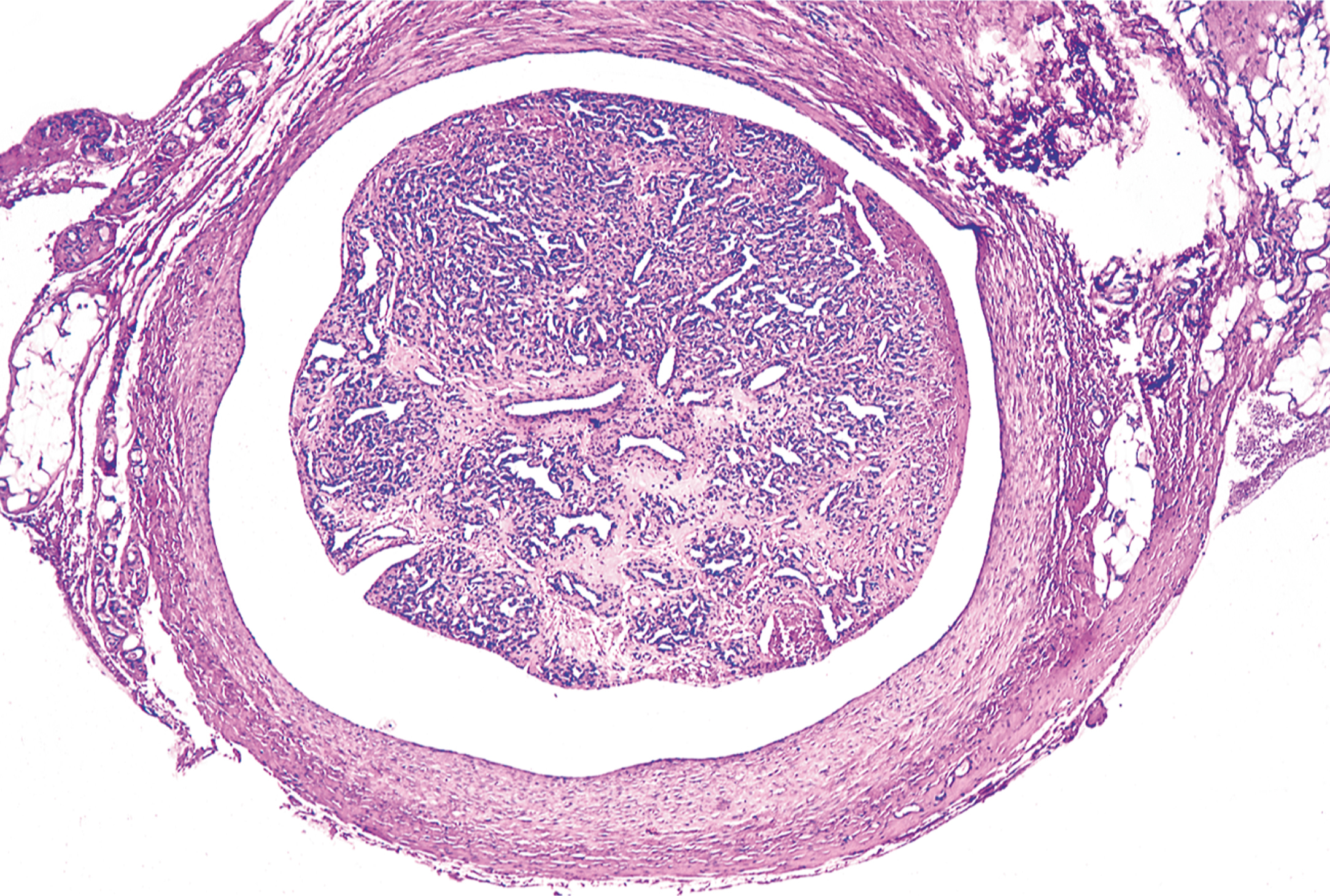 A histological section of intravascular pyogenic granuloma with a central lobular vascular proliferation surrounded by a thick vessel wall.