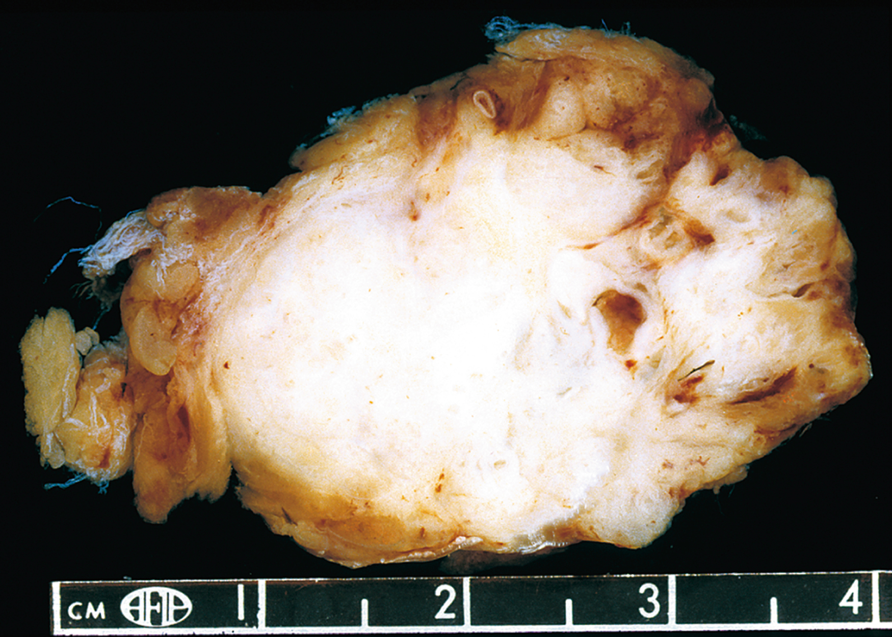A gross specimen of intramuscular mass with a solid non-hemorrhagic appearance and irregular surface measured against a centimeter scale.