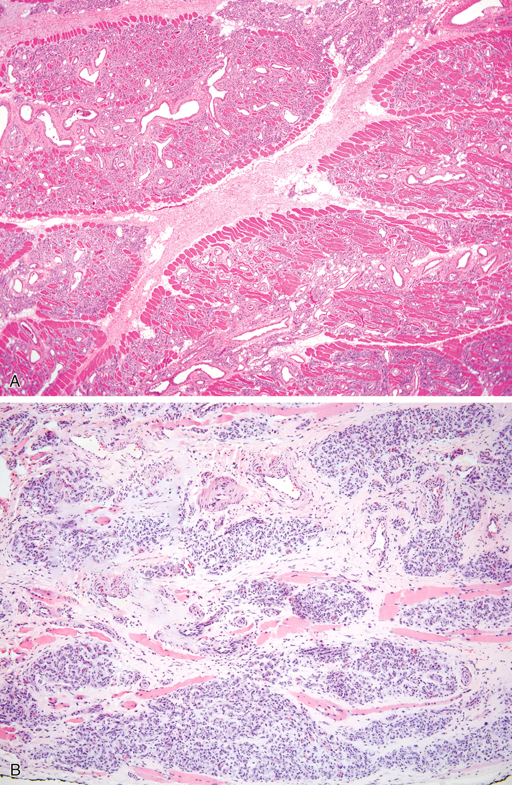 A set of two microscopic sections of intramuscular hemangioma with muscle fibers separated by vascular channels in a pseudo infiltrative growth pattern. The upper panel shows a low-power view of intramuscular hemangioma with irregular vascular channels infiltrating between muscle bundles, causing partial displacement. The lower panel at higher magnification reveals densely packed vessels with prominent endothelial lining and variable shapes within skeletal muscle. Scattered inflammatory cells are present in the stroma. The muscle fibers are separated by vascular spaces, giving a pseudo-infiltrative pattern.