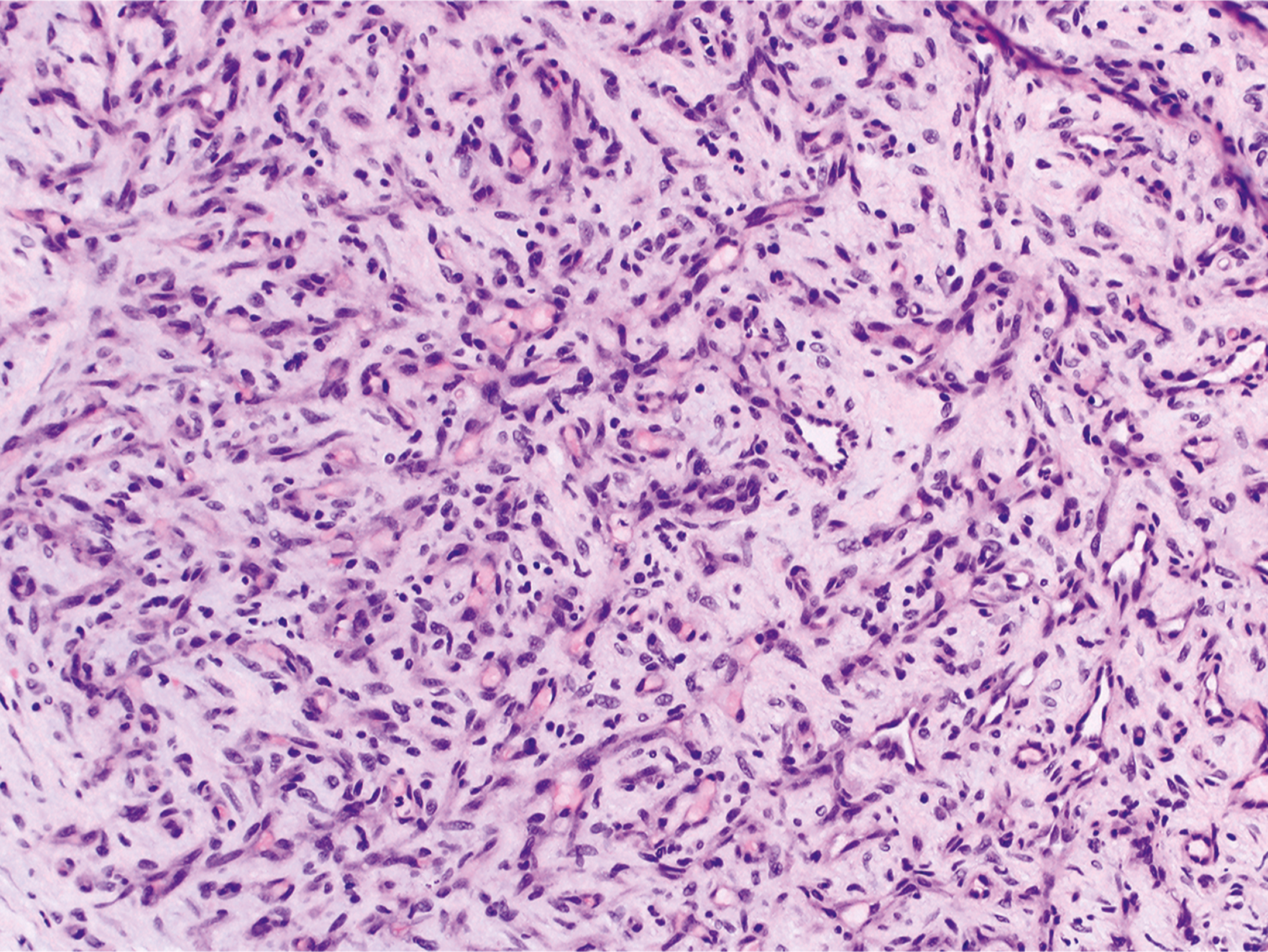 A microscopic section of small vessel-type intramuscular hemangioma composed of numerous tightly packed capillary-sized vascular channels in a fibrous stroma.