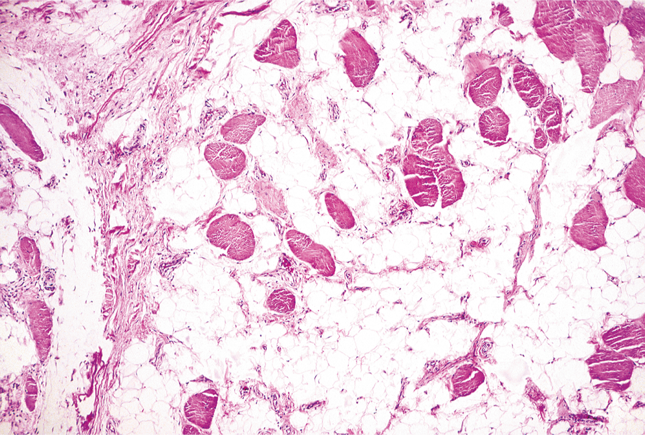 A microscopic section of intramuscular hemangioma is composed of numerous adipocytes interspersed with skeletal muscle fibers and scattered vascular channels.