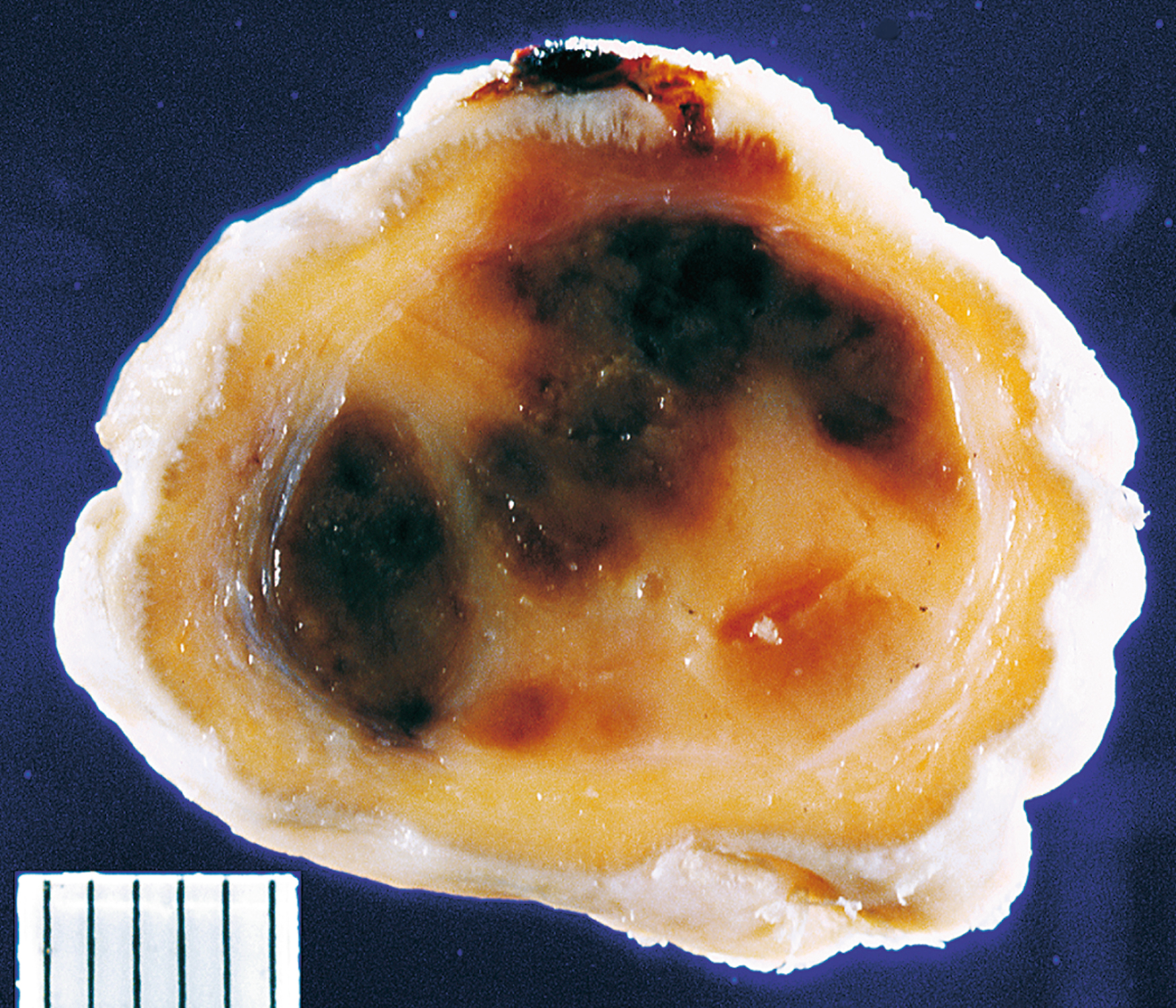 A gross section of subcutaneous epithelioid hemangioma with a well-circumscribed central cavity that contains multiple irregular darker areas surrounded by solid tissue.