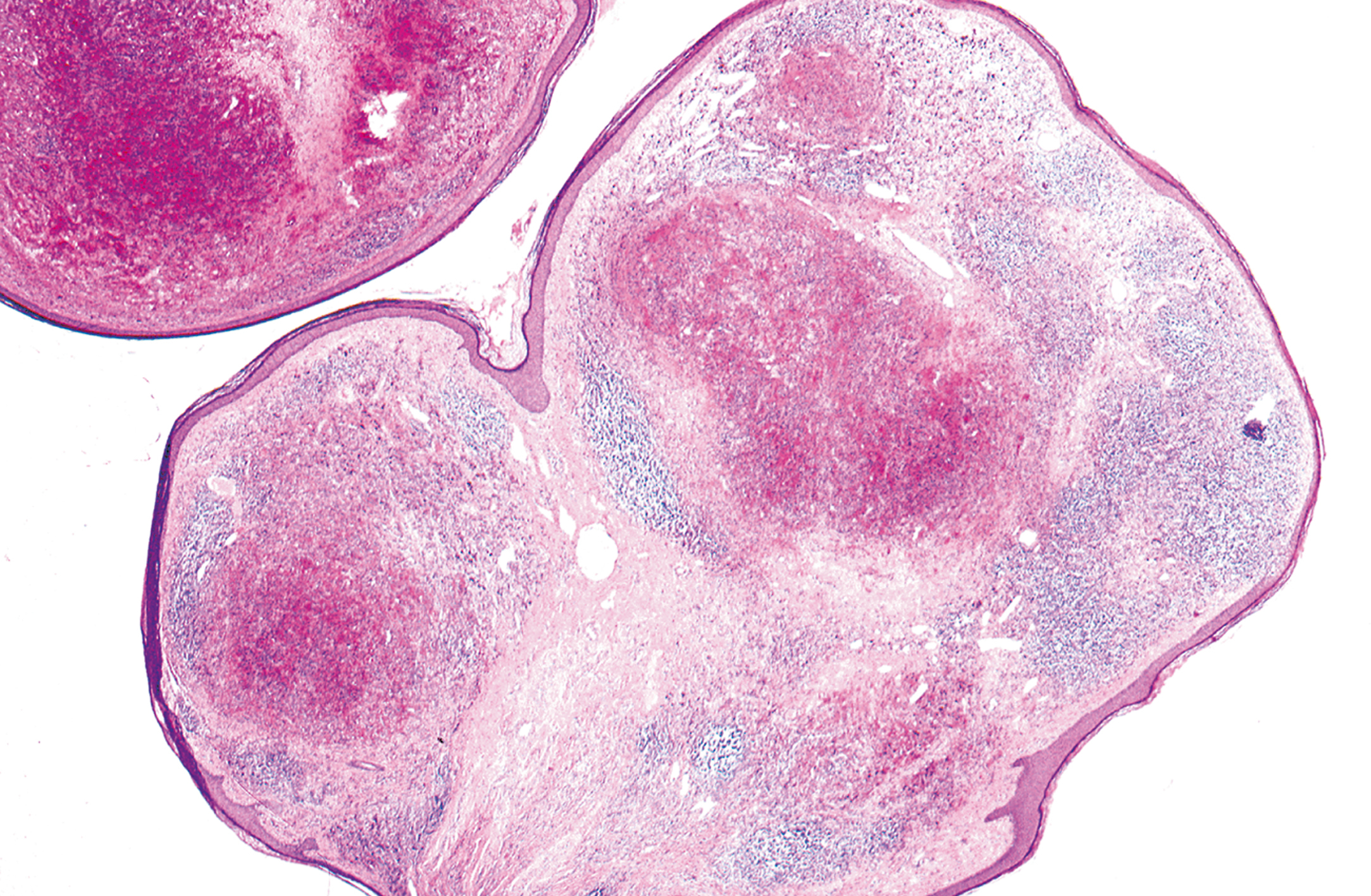 A low-power histological section of epithelioid hemangioma with multiple nodules of blood vessels surrounded by dense lymphoid cell cuffs.