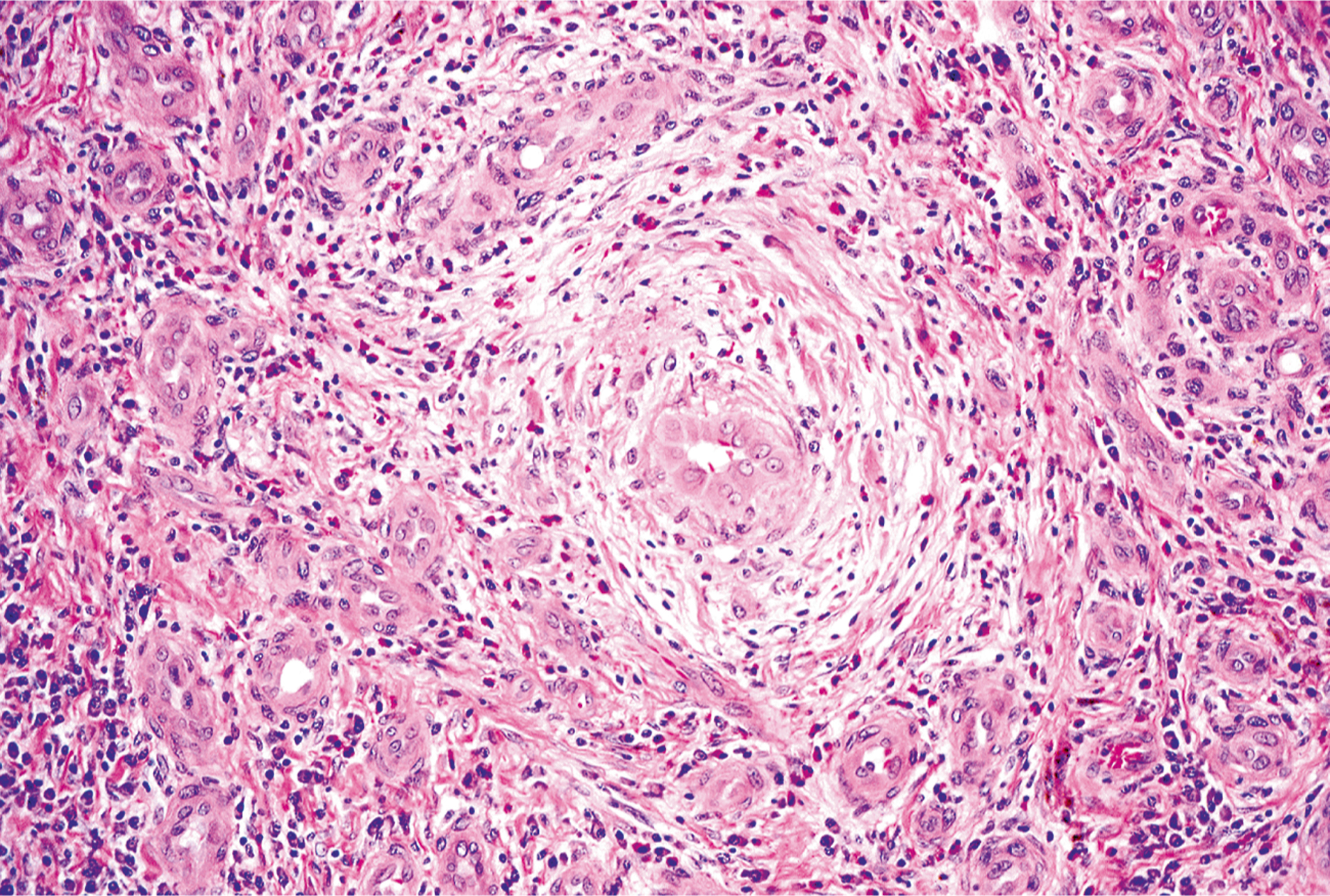 A histological section presents a high-power magnification of epithelioid hemangioma.