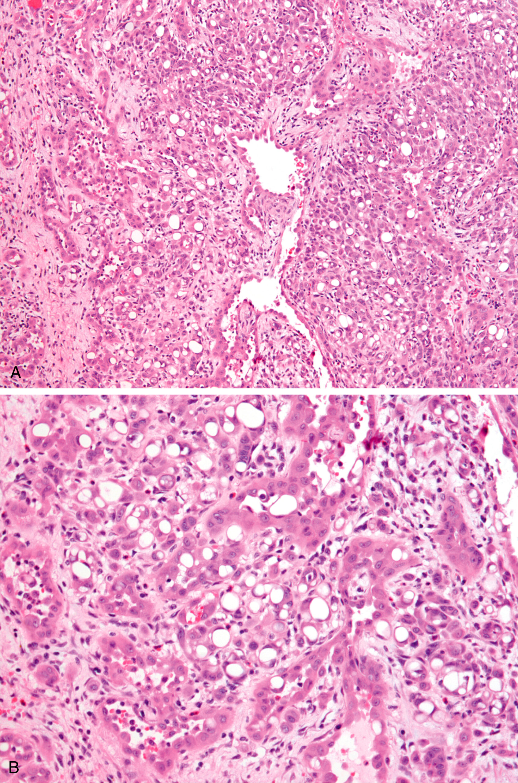 A set of two views of epithelioid hemangioma with a lobular growth pattern, including a central blood vessel and surrounding clusters of small capillary vessels.