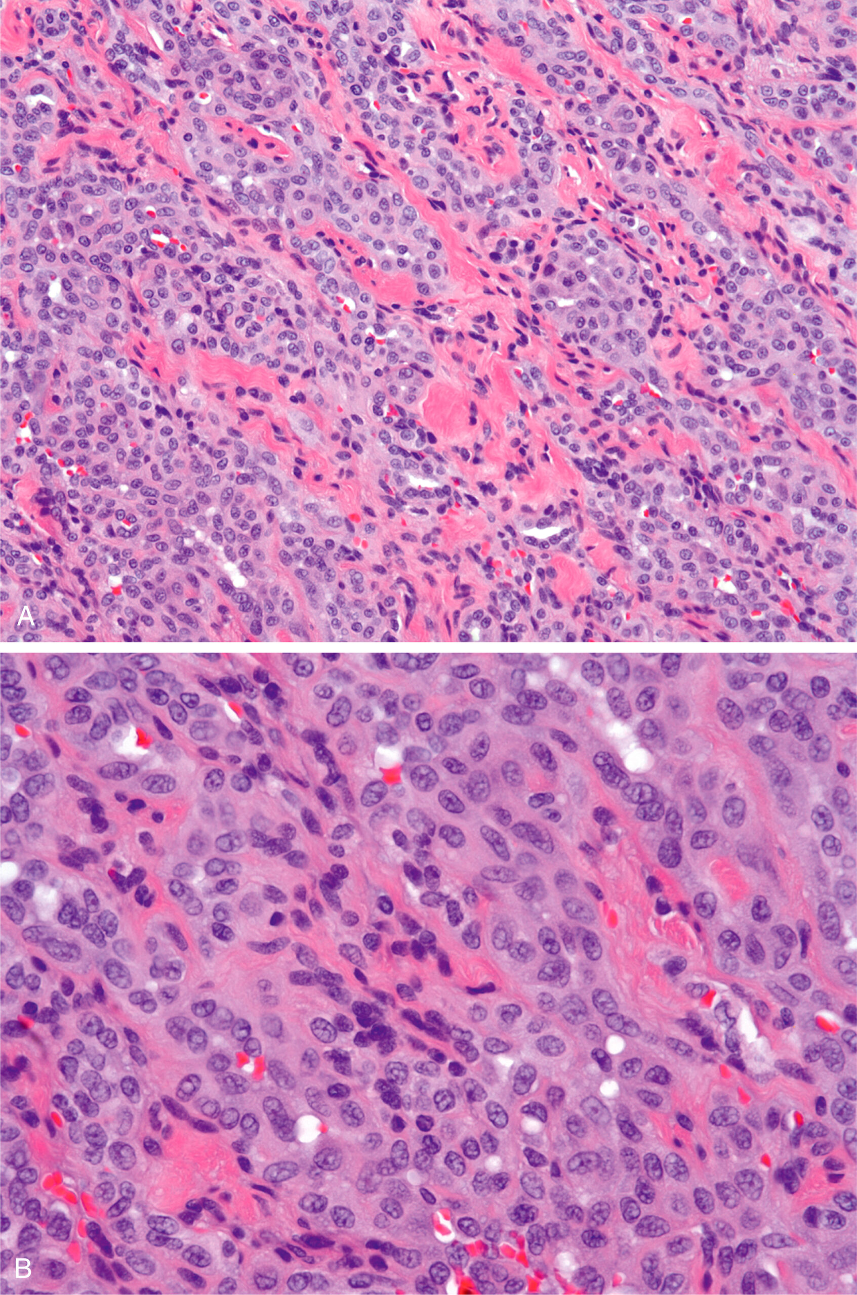 A set of two sections of solid epithelioid hemangioma with compact endothelial cells and minimal luminal formation and clefted or folded nuclei with cytoplasmic vacuoles.