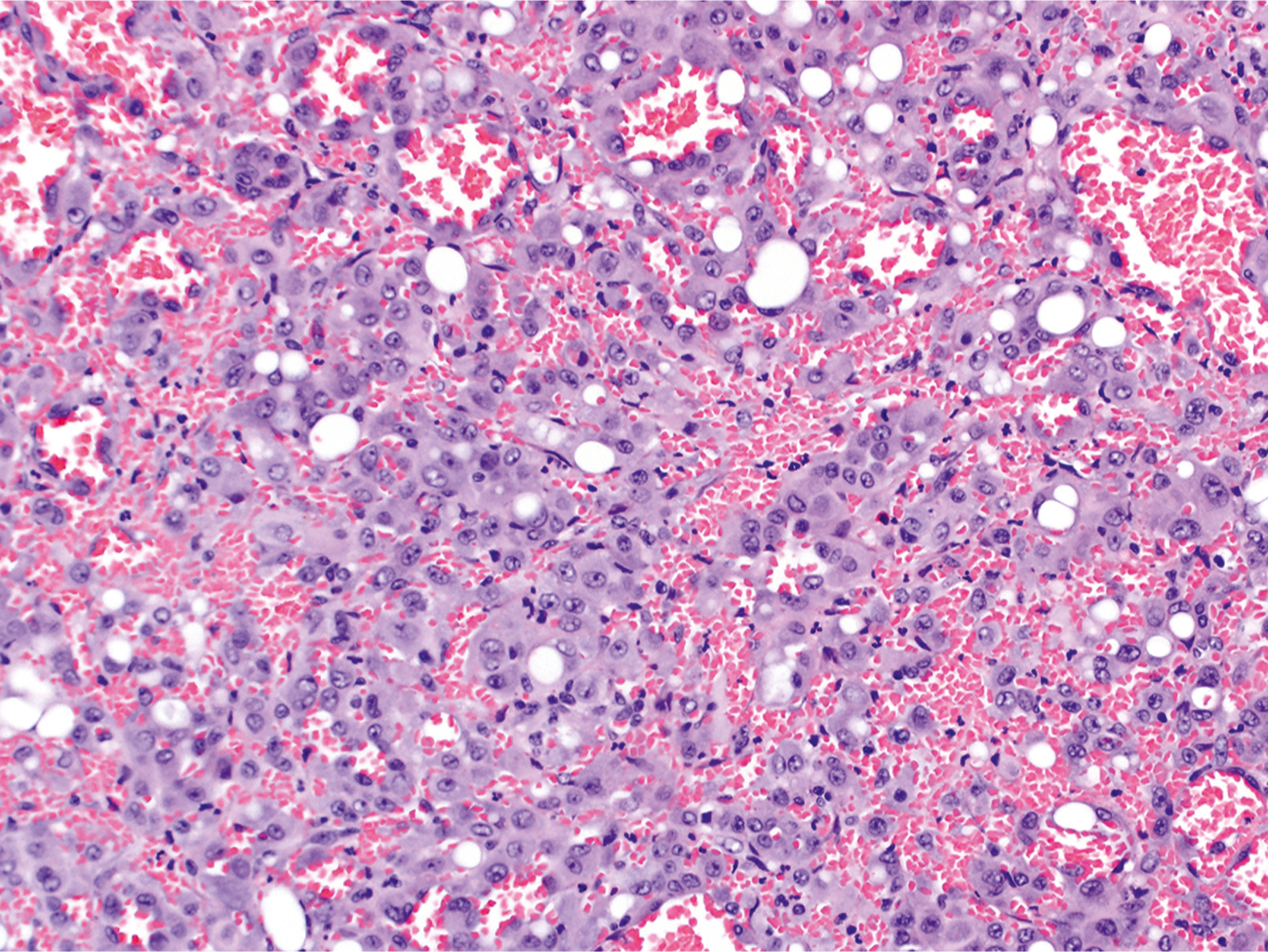 A microscopic view shows epithelioid hemangioma with subtle luminal structures and areas of intralesional hemorrhage among rounded endothelial cells and scattered vacuoles.