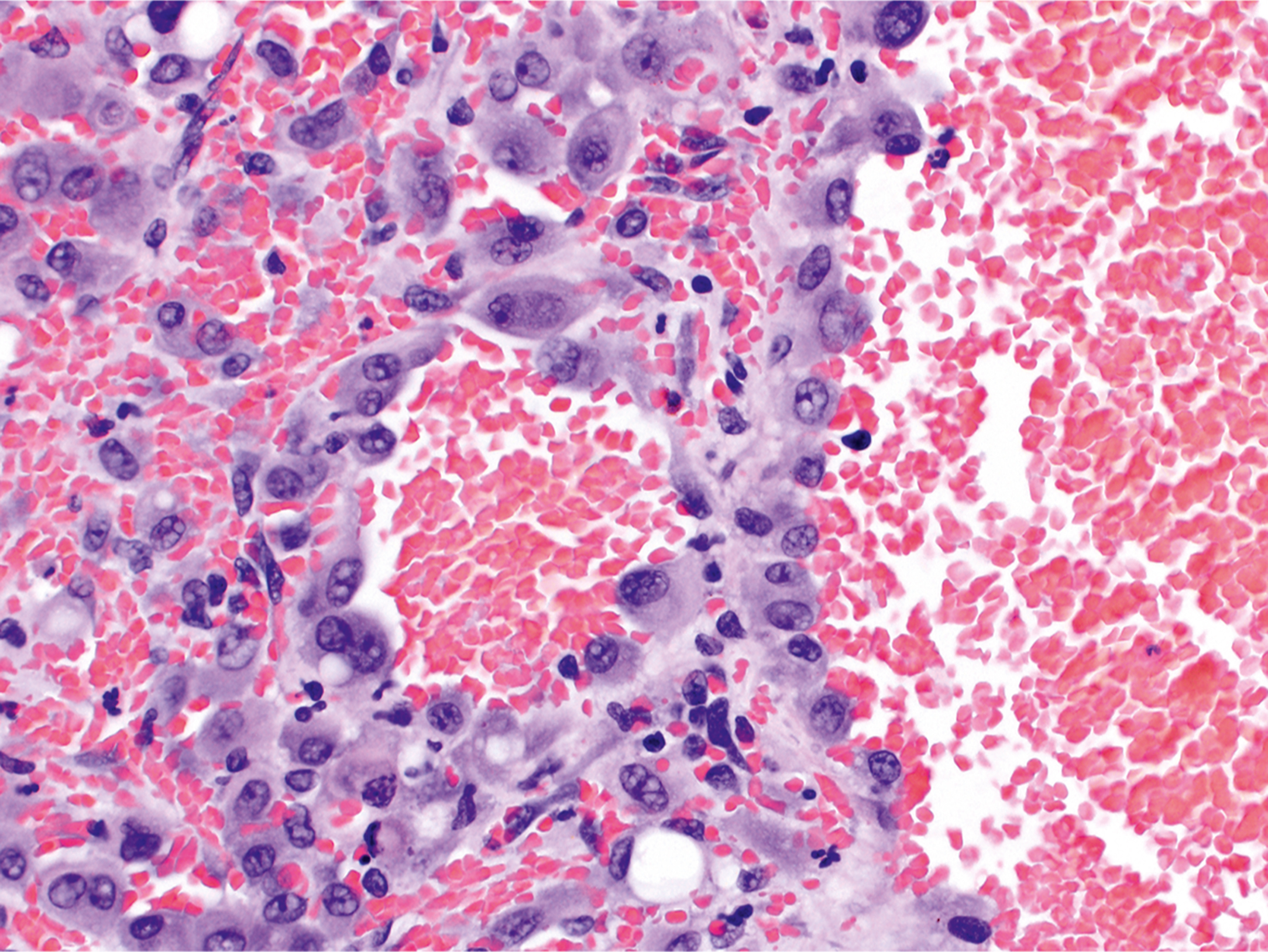 A microscopic view shows epithelioid hemangioma with intraluminal hobnailing of endothelial cells forming projections into vascular lumina and scattered vacuolated cells.