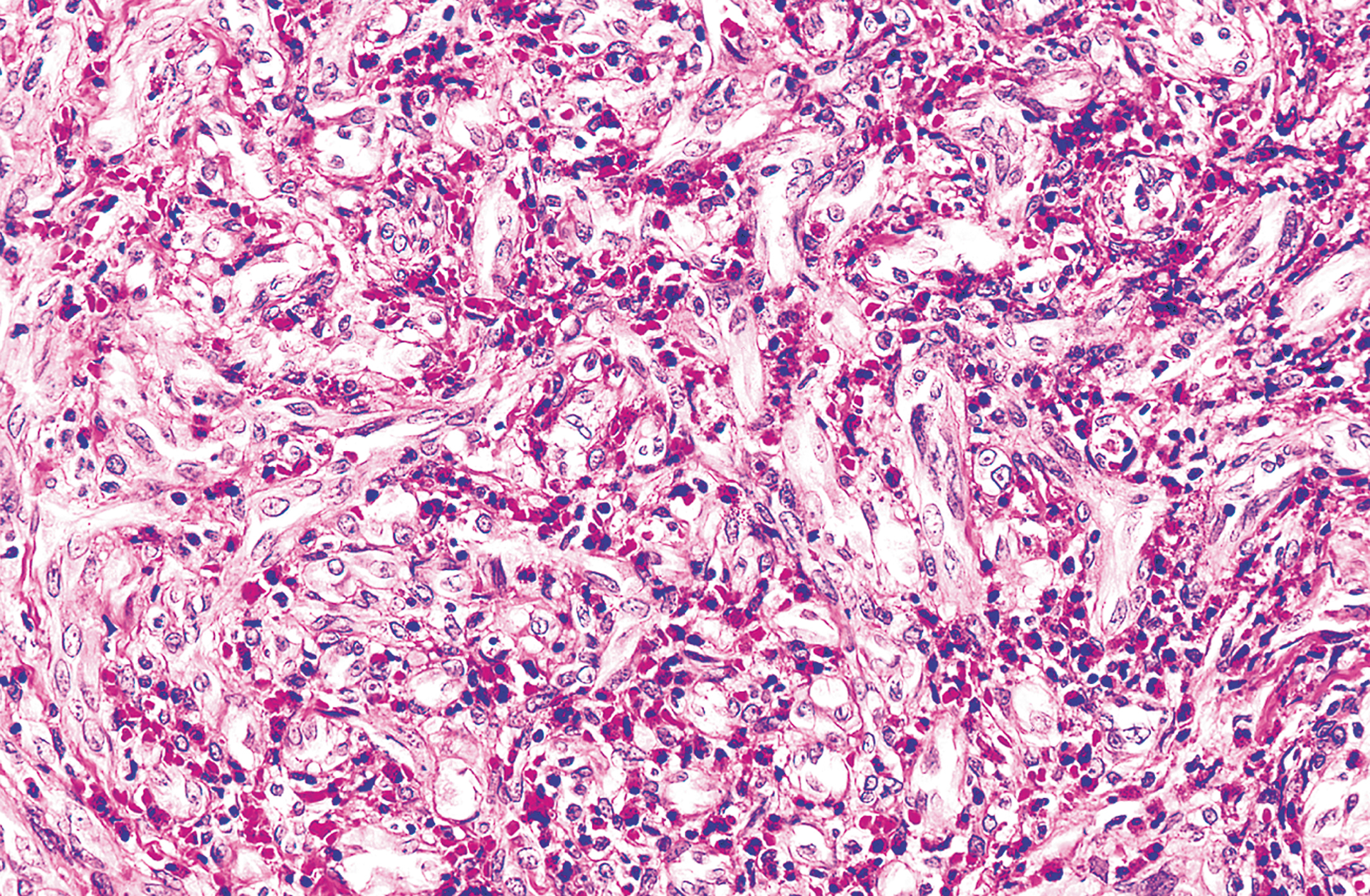 A microscopic view shows epithelioid hemangioma is composed of numerous small vascular channels.
