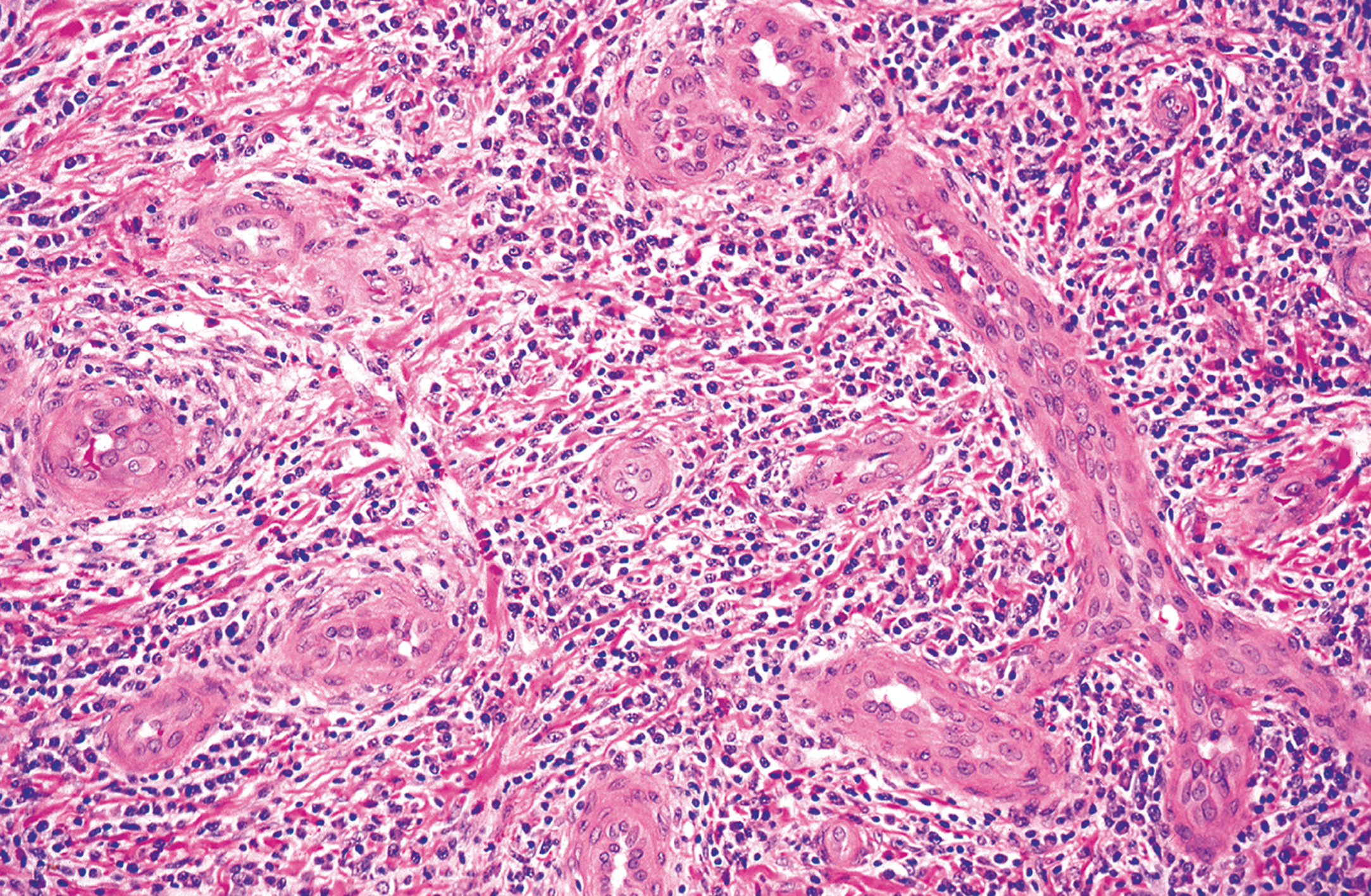 A microscopic view shows epithelioid hemangioma with regions of conventional endothelial cells and scattered chronic inflammatory cells within the vascular stroma.