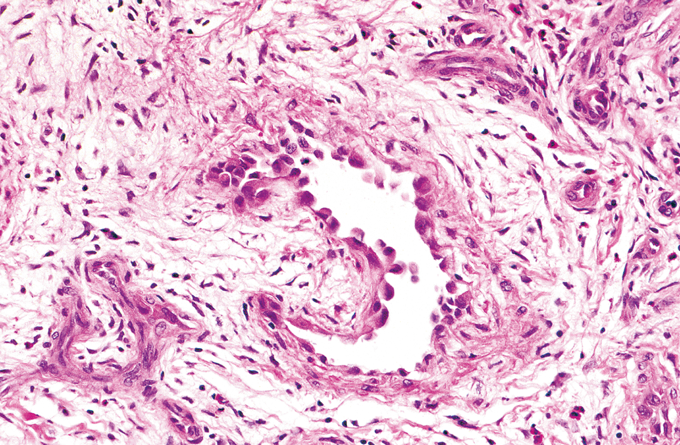 A view of epithelioid hemangioma with a large vascular channel lined by endothelial cells arranged in a tombstone-like pattern within a fibrotic stroma.