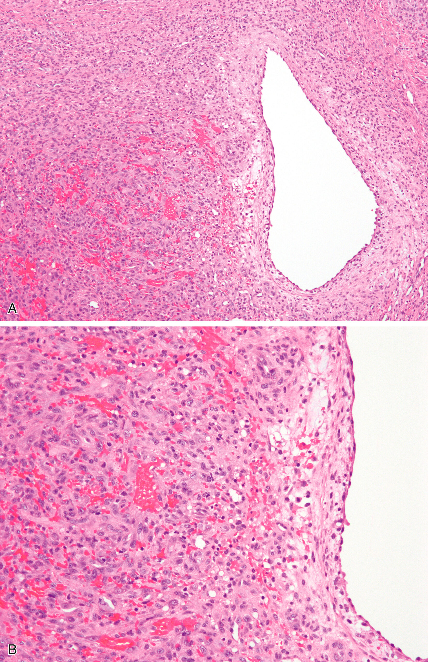 A set of two sections of epithelioid hemangioma, with one depicting a vascular lesion near a damaged vein wall and another showing epithelioid endothelial cells forming small capillary vessels. The upper section presents a low-magnification view of an epithelioid hemangioma located adjacent to the wall of a damaged vein. The vascular cavity appears irregular and is surrounded by a cellular proliferation forming a nodular lesion. Numerous small blood vessels are dispersed throughout the lesion. The surrounding stroma is moderately cellular with scattered inflammatory cells. The lower section presents a higher magnification of the same lesion. It highlights clusters of plump epithelioid endothelial cells forming small capillary-sized vascular spaces. The endothelial cells have round nuclei and are arranged in well-formed vascular structures.
