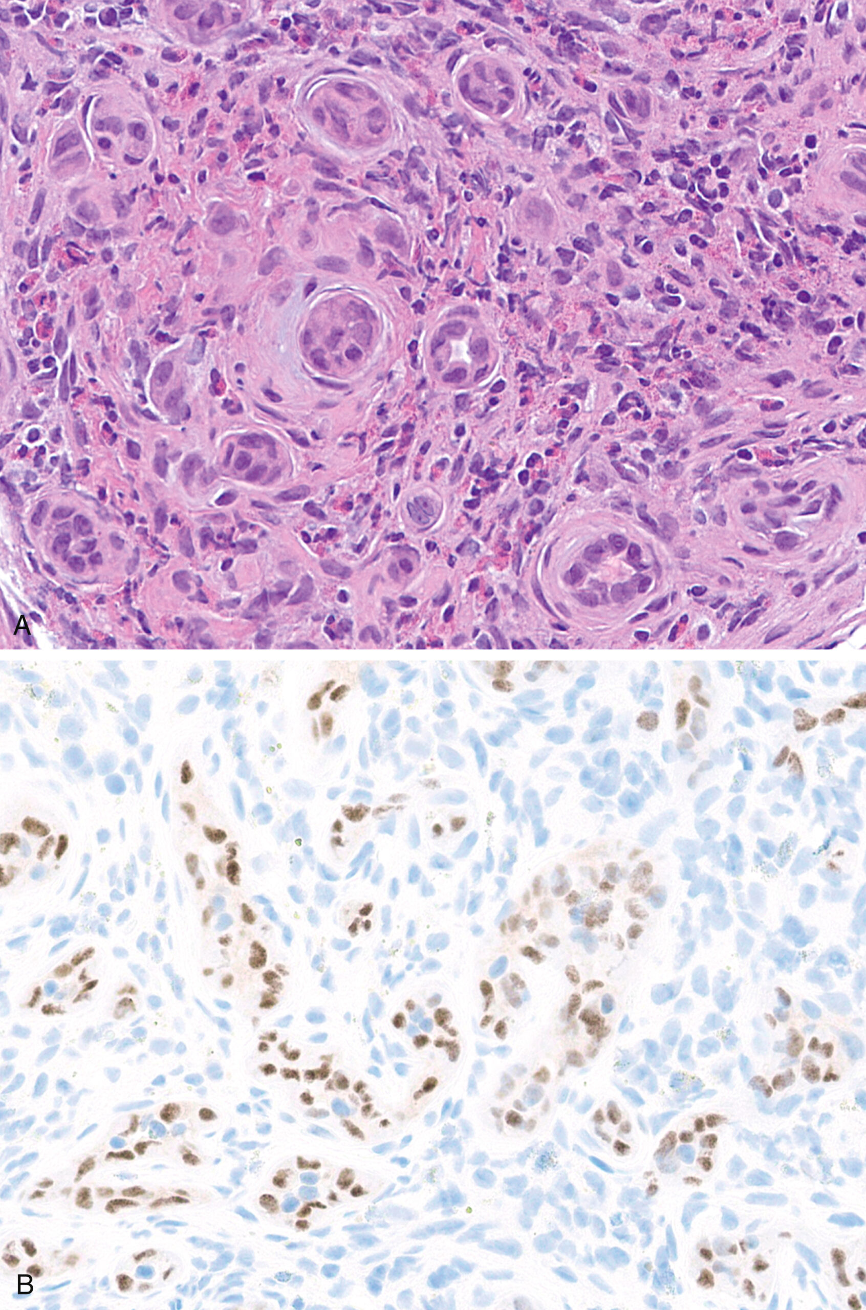 A set of two views of epithelioid hemangioma, with one displaying vascular spaces and another depicting nuclear positivity for F O S B in several endothelial cells. The upper view presents a histological section of epithelioid hemangioma with multiple well-formed vascular spaces lined by epithelioid endothelial cells. These cells have round to oval nuclei and are embedded within a moderately cellular stroma that contains scattered inflammatory cells. The lower view presents an immunohistochemical stain for F O S B. Several nuclei of the epithelioid endothelial cells exhibit strong nuclear positivity for F O S B, as evidenced by dark-stained nuclei. The staining pattern is restricted to the nuclei, while the cytoplasm remains unstained. Non-endothelial background cells appear negative or only faintly stained.