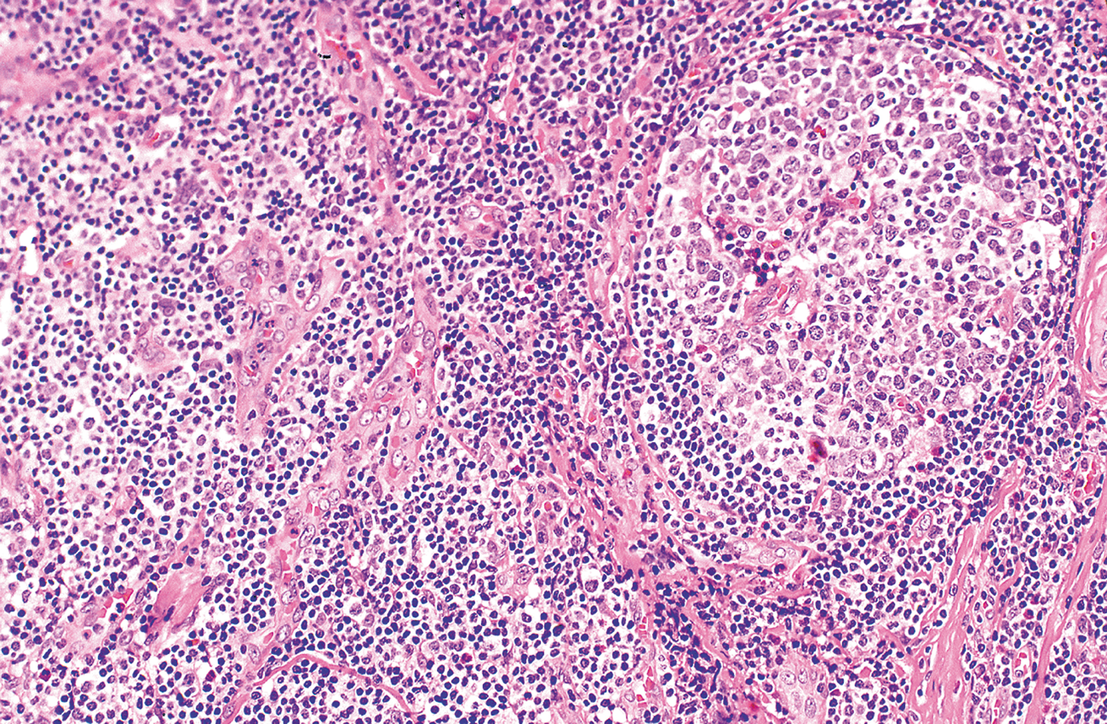 A microscopic view shows Kimura disease with dense lymphoid infiltrate and scattered vascular spaces within fibrous stroma and multiple germinal centers.