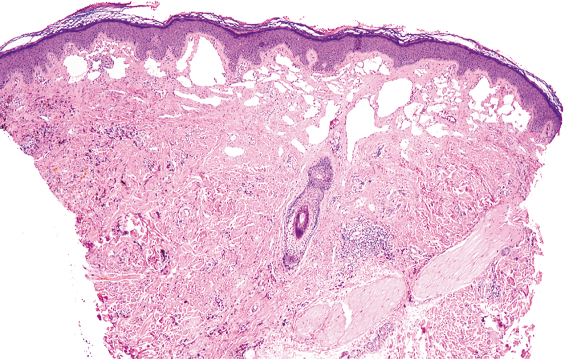 A microscopic view of hobnail hemangioma with dermal vascular spaces and hobnail endothelial cells surrounded by fibrous stroma and overlying epidermal hyperplasia.