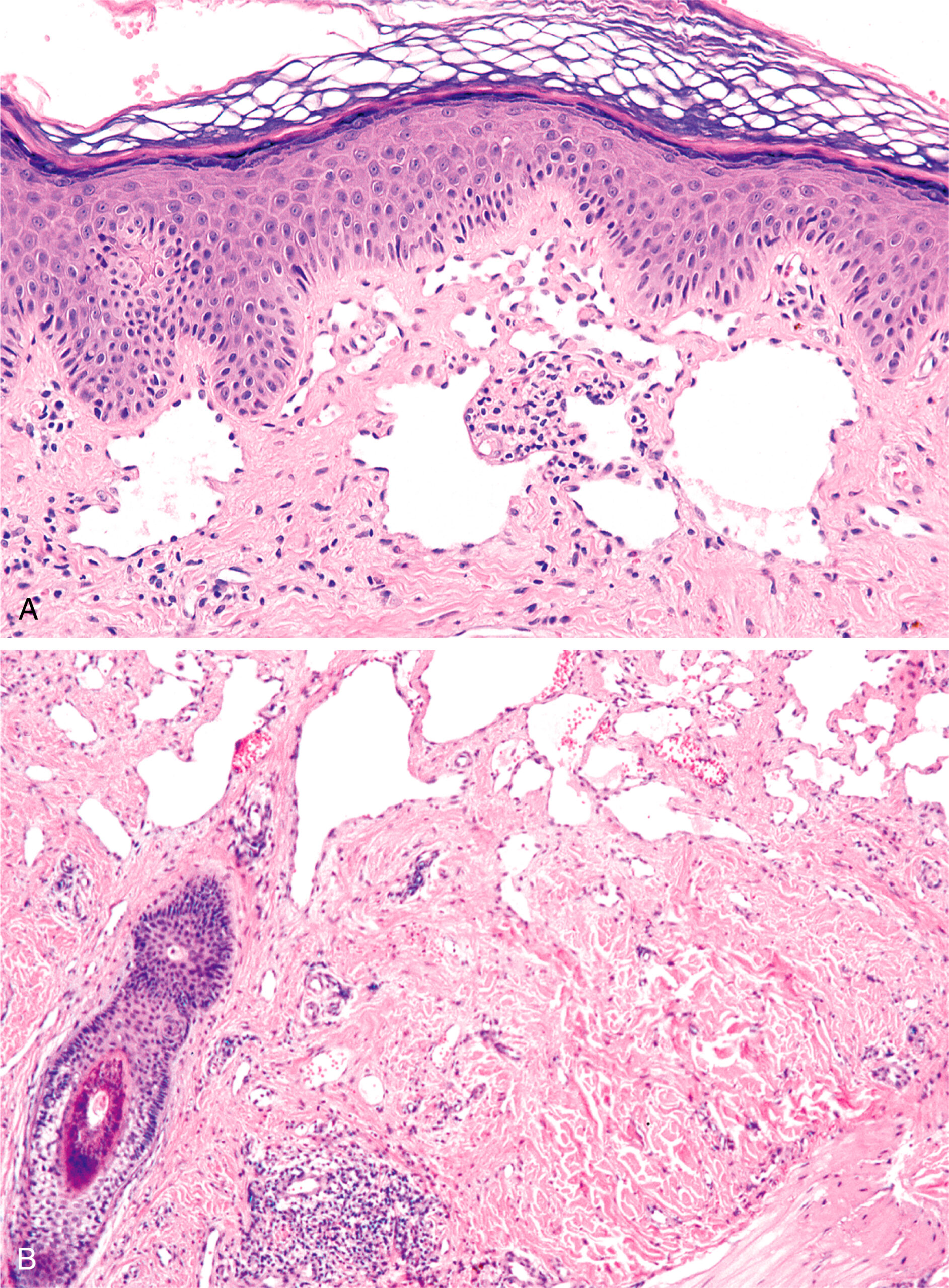 A set of two sections of hobnail hemangioma with ectatic vessels in the superficial dermis in one and deeper dermis with attenuated slitlike vessels in the other. The first panel A presents a histopathological section of a hobnail hemangioma with superficial dermis containing multiple ectatic vascular spaces. These vascular spaces lie just beneath the hyperplastic epidermis, which depicts regular acanthosis and a compact stratum corneum. The endothelial lining of these superficial vessels is flattened, and the lumen appears dilated. Scattered inflammatory cells are present around the vascular spaces. The second panel B presents a deeper section of the same lesion. It reveals vascular spaces that extend into the lower dermis. These deeper vessels are narrower, appear more slitlike, and have an attenuated endothelial lining.