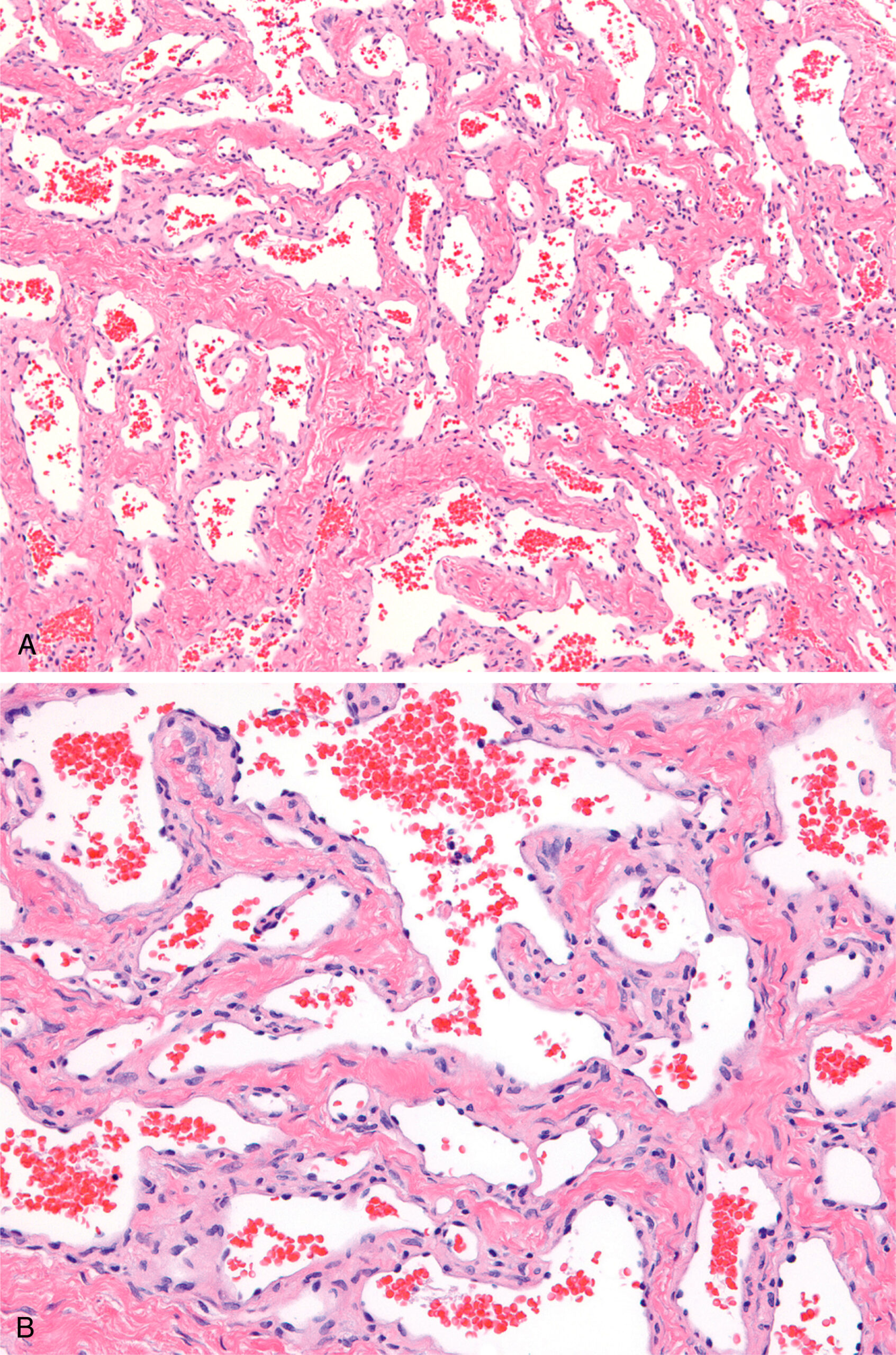 A set of two sections of sinusoidal hemangioma with interconnected vascular channels lined by bland endothelial cells and containing erythrocytes. The first part presents a low-power magnification of sinusoidal hemangioma. It consists of numerous interconnected and anastomosing vascular channels arranged in a lobular pattern. These vascular spaces contain erythrocytes and are lined by flattened endothelial cells. The surrounding stroma appears fibrous with scattered inflammatory cells. The second part presents a high-power magnification of the same lesion. It reveals the same complex arrangement of narrow, sinusoidal vascular channels. The channels are lined by bland, flattened endothelial cells without atypia. Numerous erythrocytes are present within the lumina of the vessels.