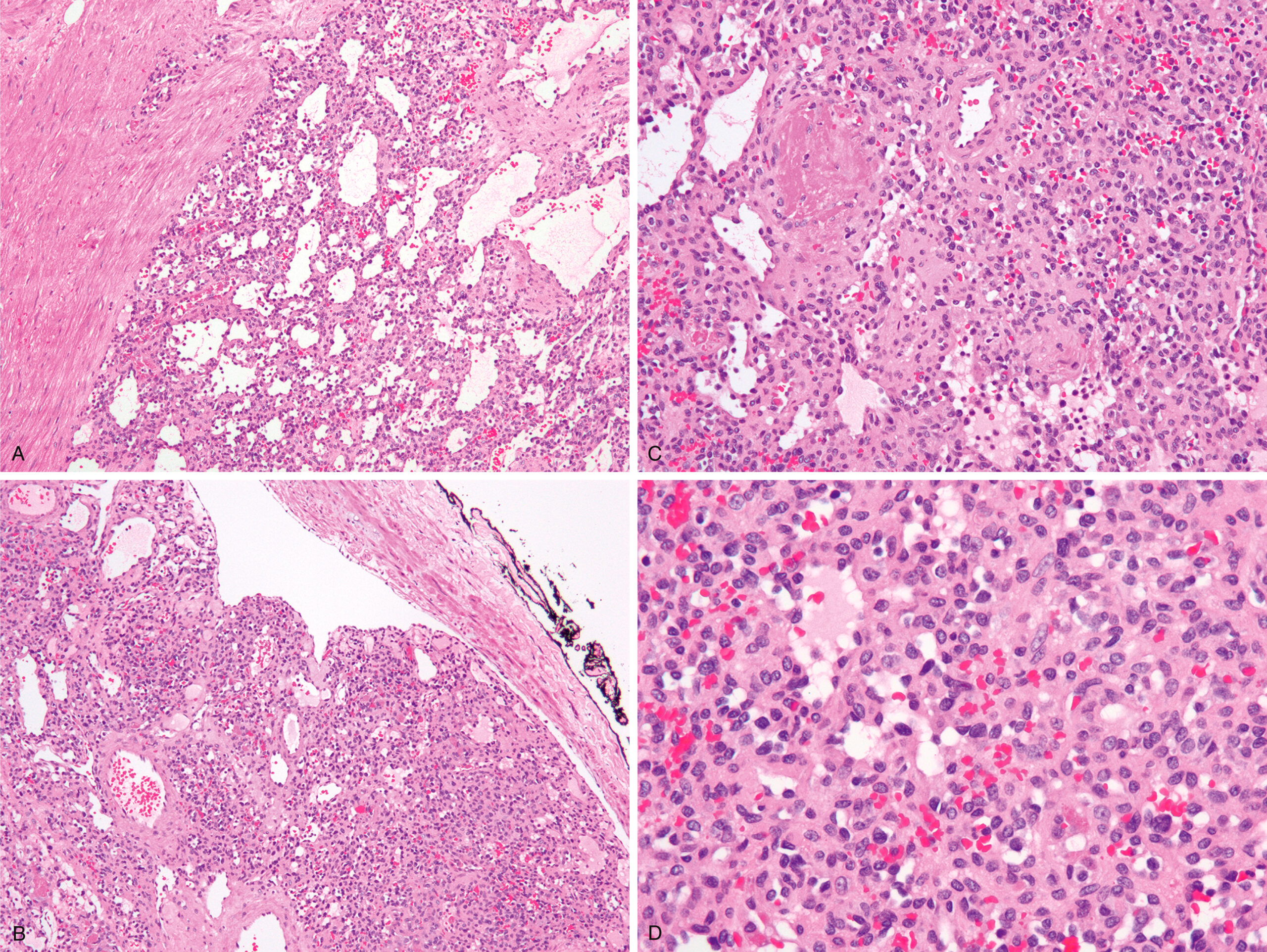 A set of four histological sections of an anastomosing hemangioma with vascular spaces and a mass arising from and occluding a retroperitoneal vein. The first histological section labeled A presents a mass with anastomosing vascular spaces originating from the wall of a retroperitoneal vein. The section includes a region where the tumor appears to interface with the vessel wall. The second section, labeled B, displays a similar architecture of anastomosing vascular channels and indicates that the tumor largely occludes the lumen of the involved vein. The structure of the vessel wall is identifiable, and the tumor occupies a significant portion of the vascular space. The third histological section labeled C presents an anastomosing hemangioma with a non-lobular pattern and numerous small capillary-sized vascular channels that interconnect. The endothelial cells lining the vascular spaces appear slightly protuberant. Scattered small thrombi are present within the tissue. The fourth section, labeled D, provides a higher magnification view where the vascular architecture and the endothelial cells are more clearly seen. The nuclei of the endothelial cells appear round to oval, and the background contains numerous red blood cells and supporting stromal cells.