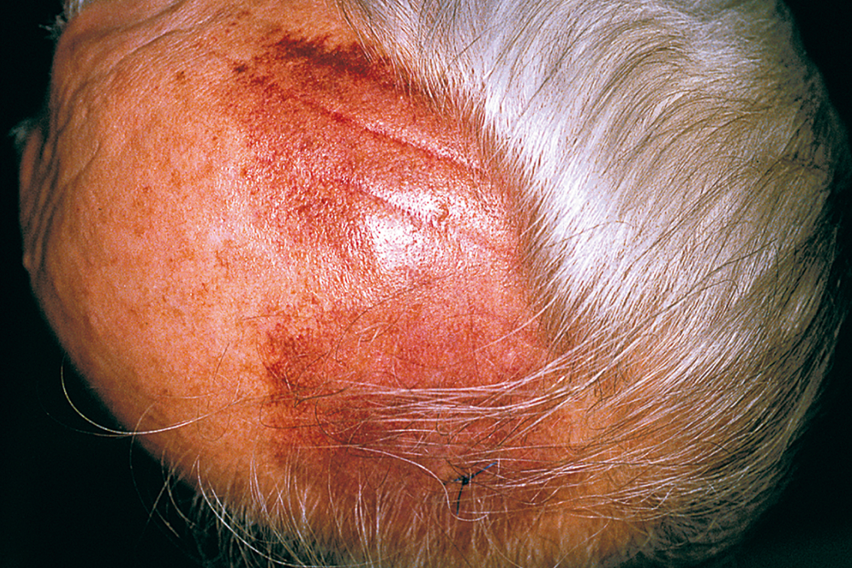 A photo of an older person’s scalp with a receded hairline exhibits a raised, irregular patch with overlying hair and a shiny, wrinkled skin surface on the crown region.