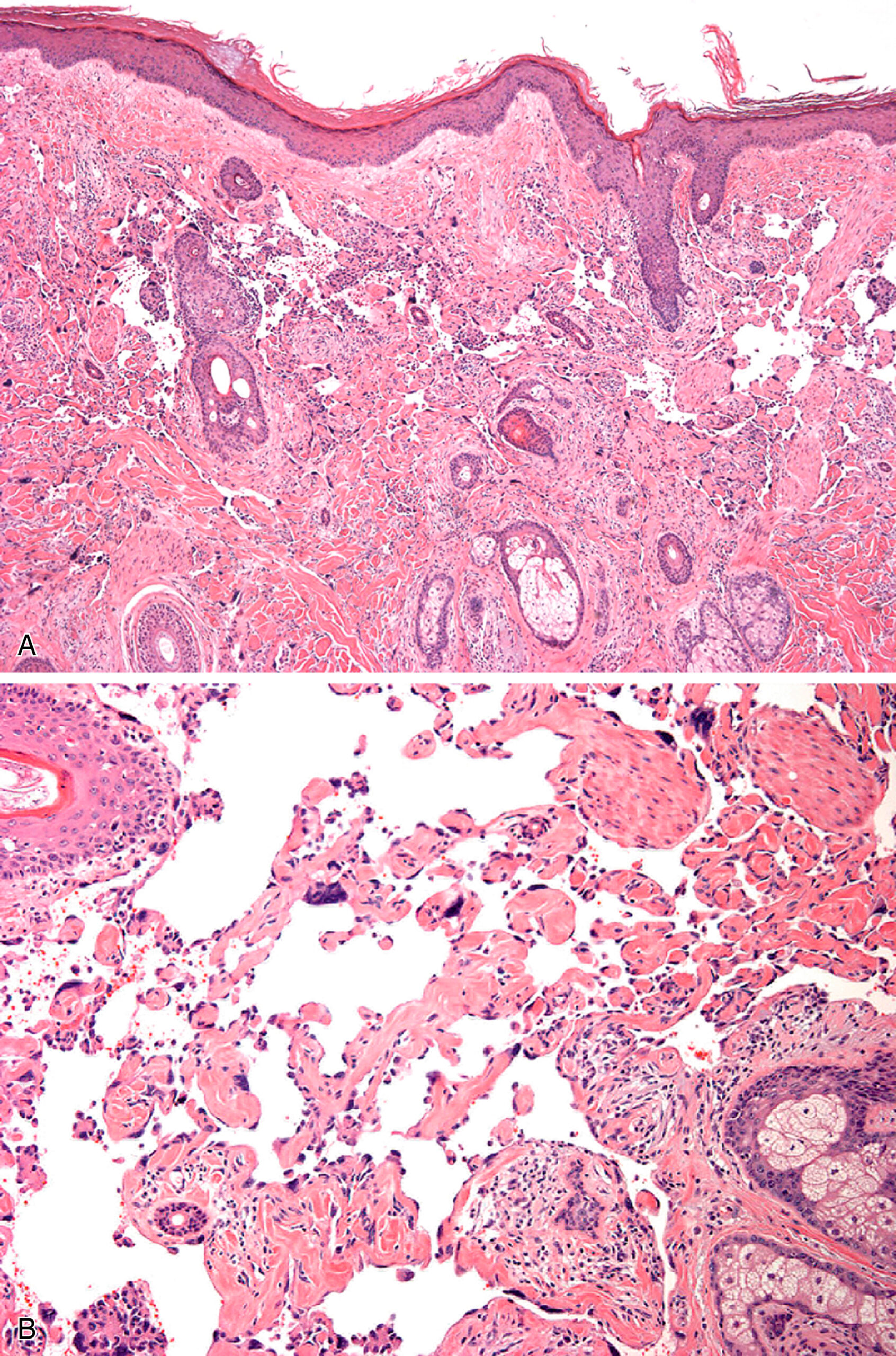 A histological section of skin tissue with vascular spaces, cellular proliferation, and variable architecture in both layers. The upper section presents epidermis at the top and underlying dermis displaying vascular channels and proliferative spindle cell areas. The dermis contains irregular slit-like vascular spaces dispersed throughout a cellular stroma. The lower section displays a histological section with alveolar spaces, vascular channels, and patchy cellular proliferation in the interalveolar septa. Bronchiolar and alveolar structures are surrounded by spindle cells and vascular formations. The tissue architecture in both sections is abnormal, with the presence of vascular proliferation and increased cellularity.
