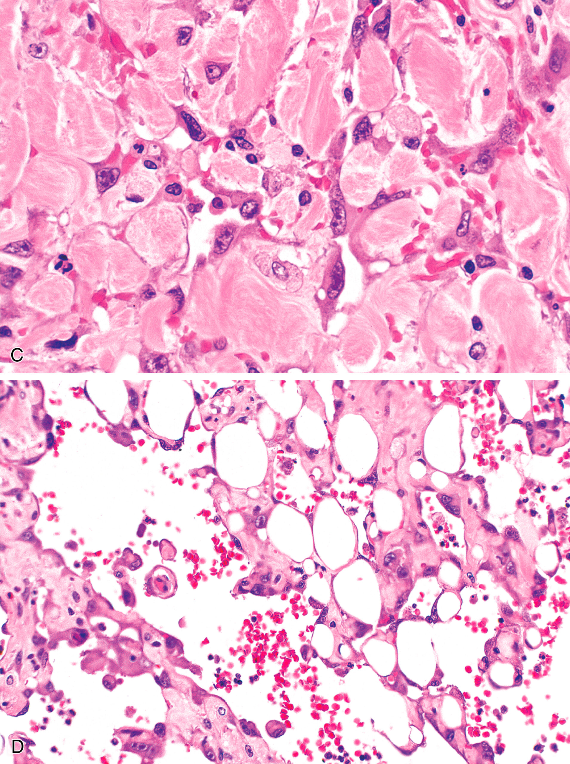 A histological section of skin tissue with vascular spaces, cellular proliferation, and variable architecture in both layers. The upper section presents epidermis at the top and underlying dermis displaying vascular channels and proliferative spindle cell areas. The dermis contains irregular slit-like vascular spaces dispersed throughout a cellular stroma. The lower section displays a histological section with alveolar spaces, vascular channels, and patchy cellular proliferation in the interalveolar septa. Bronchiolar and alveolar structures are surrounded by spindle cells and vascular formations. The tissue architecture in both sections is abnormal, with the presence of vascular proliferation and increased cellularity.