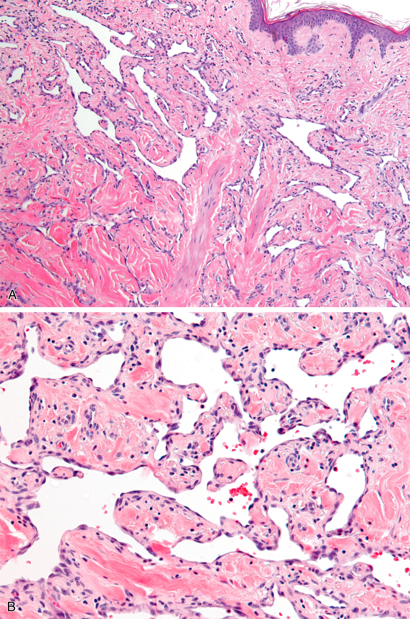 A histological section of the skin with epithelial proliferation in the dermis and alveolar spaces is lined by atypical cells and an inflammatory infiltrate. The upper section presents a histological section of the skin with the epidermis at the top and the dermis beneath it. The dermis contains irregular epithelial cell proliferation with gland-like structures separated by fibrous stroma. The architecture appears disrupted with the infiltration of surrounding connective tissue. The lower section depicts spaces partially lined by atypical cuboidal to columnar cells. The borders appear thickened with infiltration of inflammatory cells and occasional red blood cells within capillaries. The tissue exhibits abnormal proliferation and inflammatory changes.