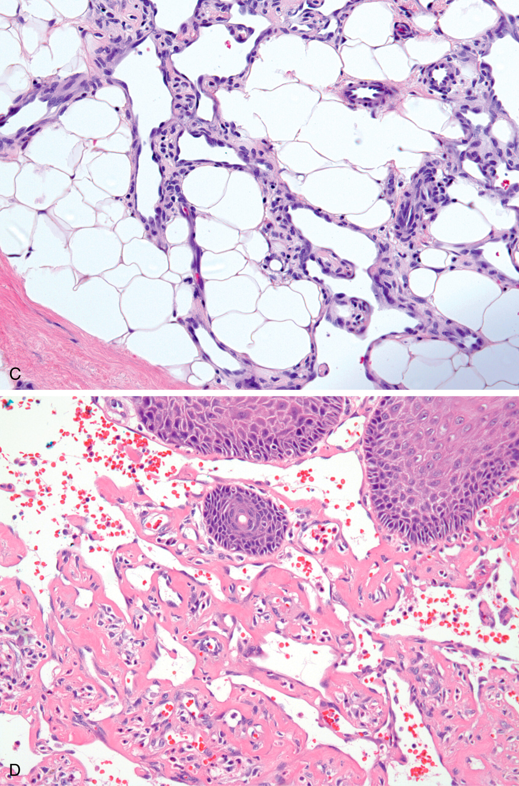 A histological section of the skin with epithelial proliferation in the dermis and alveolar spaces is lined by atypical cells and an inflammatory infiltrate. The upper section presents a histological section of the skin with the epidermis at the top and the dermis beneath it. The dermis contains irregular epithelial cell proliferation with gland-like structures separated by fibrous stroma. The architecture appears disrupted with the infiltration of surrounding connective tissue. The lower section depicts spaces partially lined by atypical cuboidal to columnar cells. The borders appear thickened with infiltration of inflammatory cells and occasional red blood cells within capillaries. The tissue exhibits abnormal proliferation and inflammatory changes.