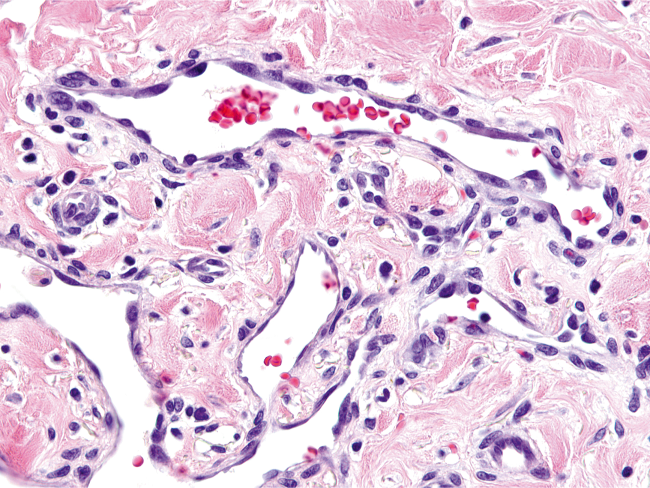 A histological section exhibits dermal collagen bundles, erythrocyte‐filled dilated capillaries, and a dense inflammatory cell infiltrate within the dermal stroma.