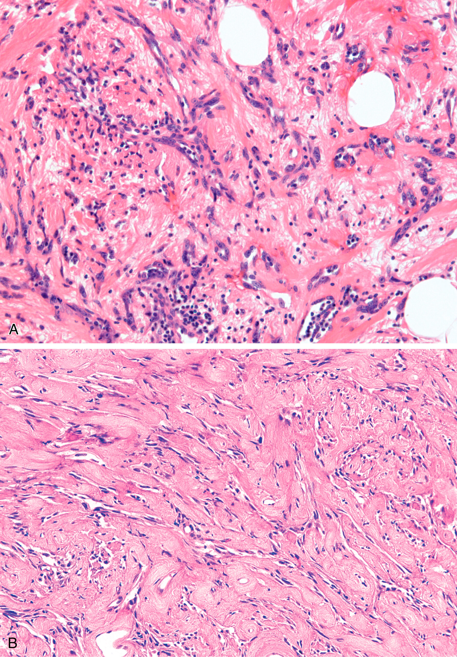 A histological section with the upper area containing dense inflammatory cell infiltration and the lower area consisting of compact fibrous tissue with elongated nuclei. The histological section contains two sections. In the upper section, there is a dense infiltration of inflammatory cells dispersed within a fibrous stroma. Multiple round nuclei are scattered throughout, and several circular empty spaces suggest the presence of adipocytes. In the lower section, the tissue appears more fibrotic with dense bundles of collagen and elongated spindle-shaped nuclei aligned in parallel. This region presents reduced cellularity compared to the upper part. The entire section displays variation in cellular density and fibrous tissue organization.