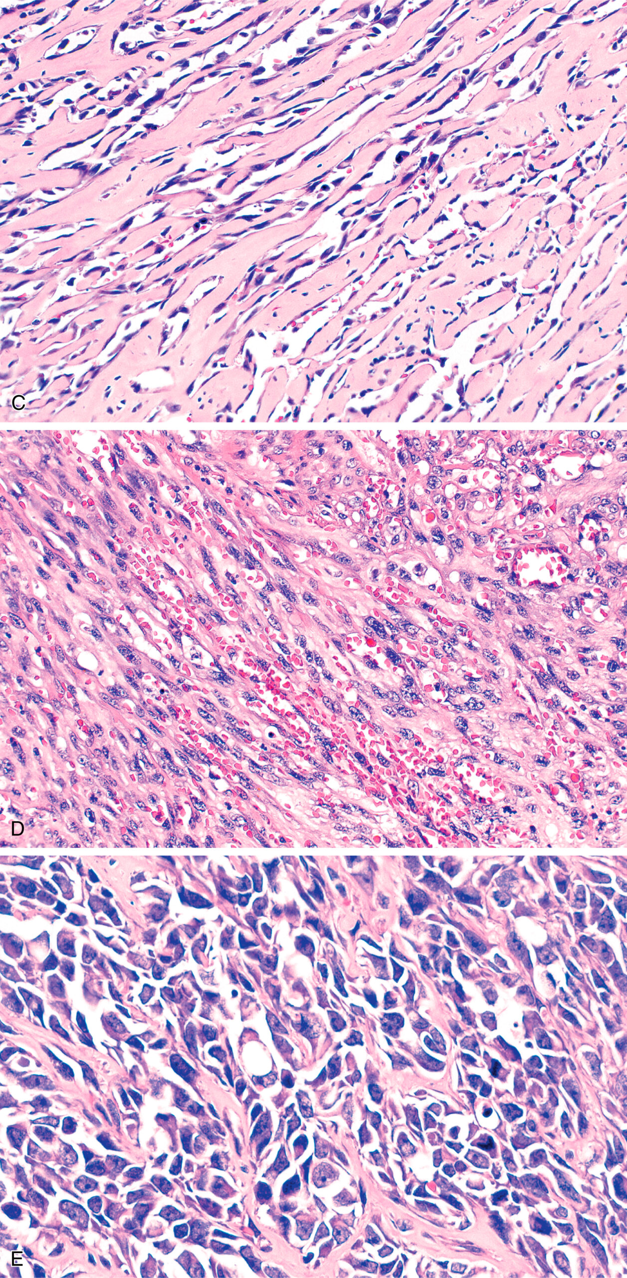 A histological section with the upper area containing dense inflammatory cell infiltration and the lower area consisting of compact fibrous tissue with elongated nuclei. The histological section contains two sections. In the upper section, there is a dense infiltration of inflammatory cells dispersed within a fibrous stroma. Multiple round nuclei are scattered throughout, and several circular empty spaces suggest the presence of adipocytes. In the lower section, the tissue appears more fibrotic with dense bundles of collagen and elongated spindle-shaped nuclei aligned in parallel. This region presents reduced cellularity compared to the upper part. The entire section displays variation in cellular density and fibrous tissue organization.
