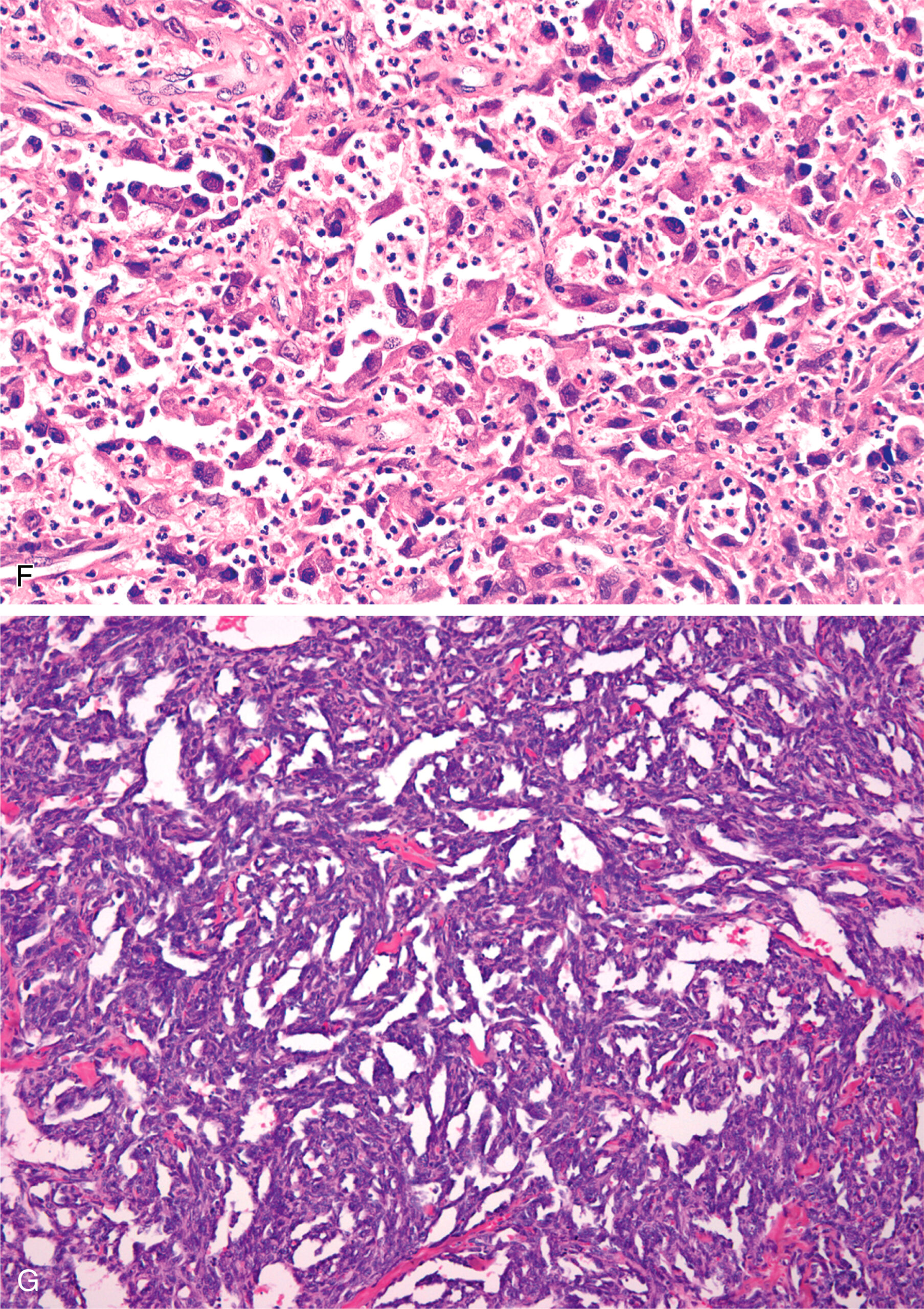 A histological section with the upper area containing dense inflammatory cell infiltration and the lower area consisting of compact fibrous tissue with elongated nuclei. The histological section contains two sections. In the upper section, there is a dense infiltration of inflammatory cells dispersed within a fibrous stroma. Multiple round nuclei are scattered throughout, and several circular empty spaces suggest the presence of adipocytes. In the lower section, the tissue appears more fibrotic with dense bundles of collagen and elongated spindle-shaped nuclei aligned in parallel. This region presents reduced cellularity compared to the upper part. The entire section displays variation in cellular density and fibrous tissue organization.