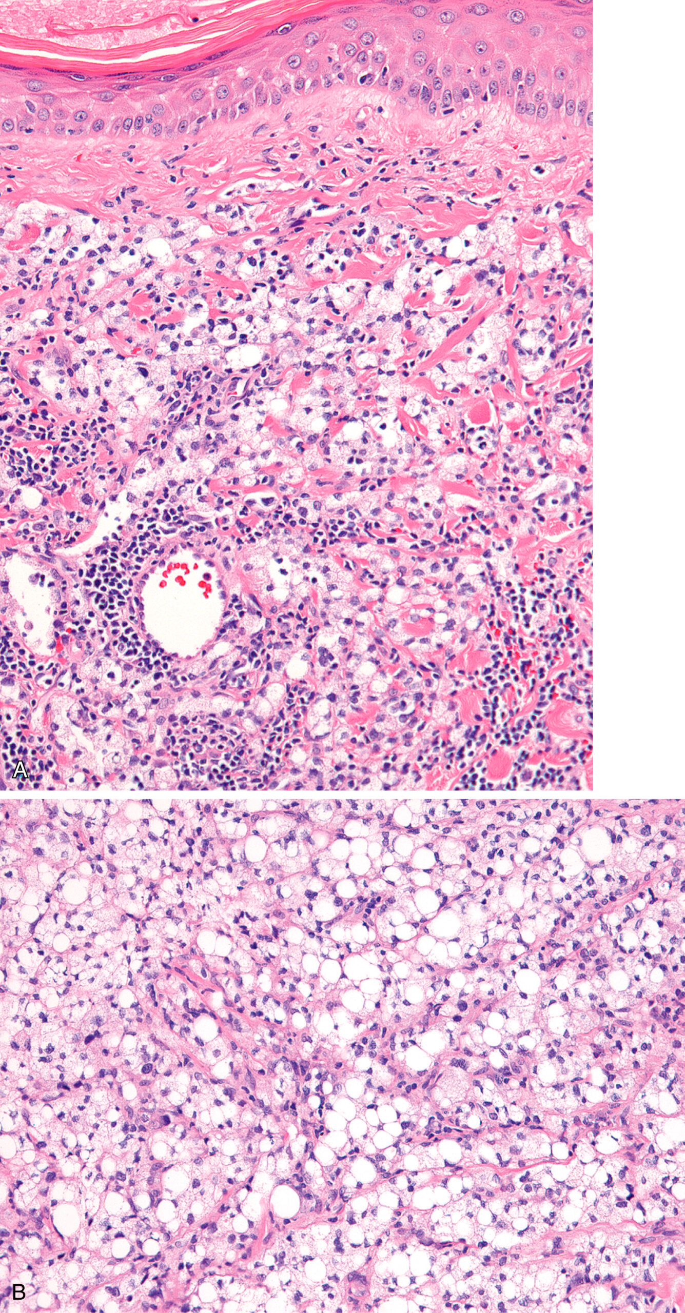 A histological section exhibits stratified epithelium overlying sheets of inflammatory cells and numerous clear vacuolated cells. The upper section displays a stratified squamous epithelial layer with underlying connective tissue infiltrated by numerous inflammatory cells. Within this area, several dilated vascular channels are visible, and clusters of small round cells with dark nuclei are interspersed throughout the stromal region. The section contains numerous clear vacuolated cells arranged in a lobular pattern, with some areas revealing eccentric nuclei. The background stroma appears loose and vascular, supporting the arrangement of the vacuolated cells across the lower field.