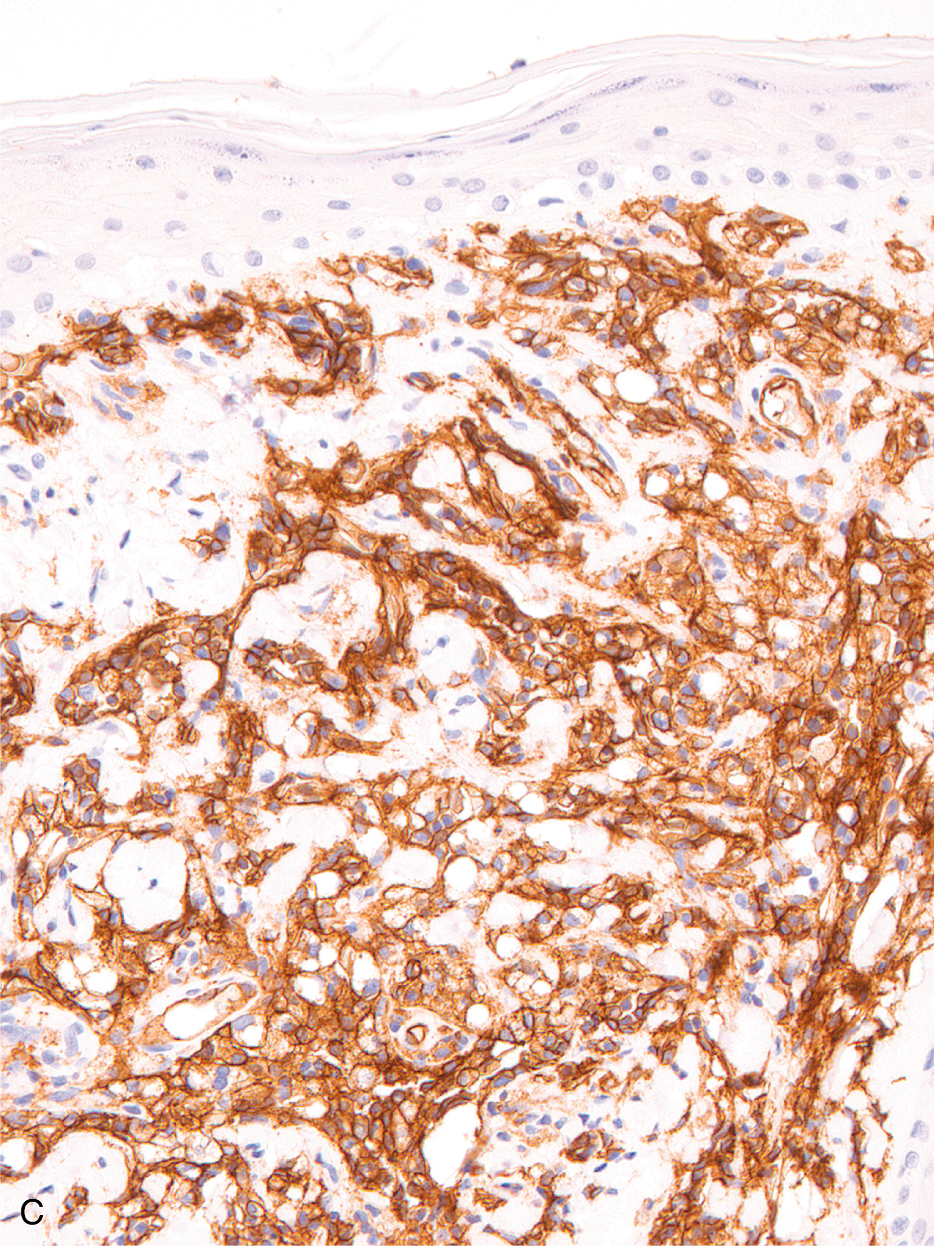 A histological section exhibits stratified epithelium overlying sheets of inflammatory cells and numerous clear vacuolated cells. The upper section displays a stratified squamous epithelial layer with underlying connective tissue infiltrated by numerous inflammatory cells. Within this area, several dilated vascular channels are visible, and clusters of small round cells with dark nuclei are interspersed throughout the stromal region. The section contains numerous clear vacuolated cells arranged in a lobular pattern, with some areas revealing eccentric nuclei. The background stroma appears loose and vascular, supporting the arrangement of the vacuolated cells across the lower field.