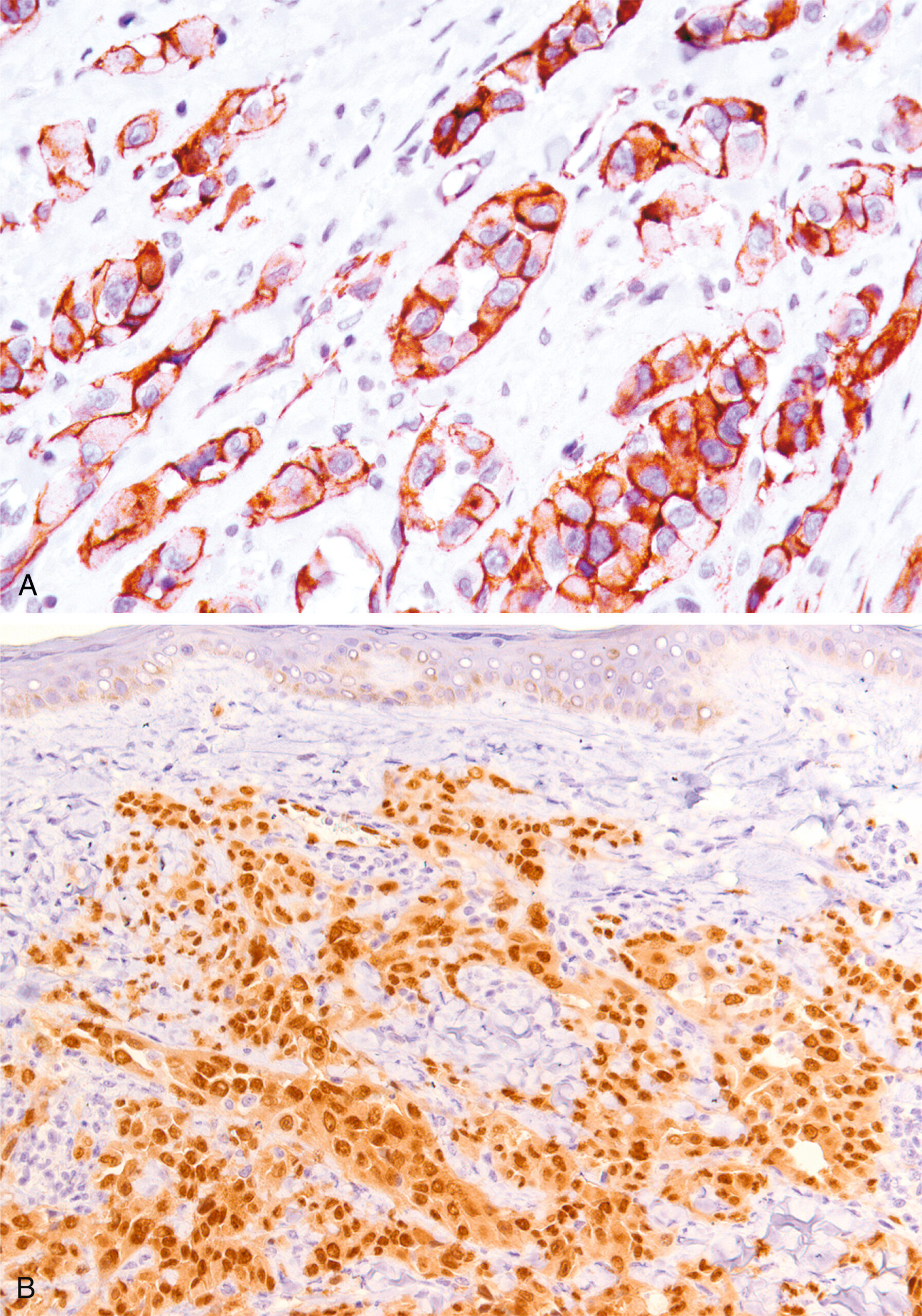 A section contains two panels of stained tissue, with the top panel displaying elongated glandular structures and the bottom panel showing densely packed cells with cytoplasmic staining. The top panel shows elongated glandular structures in parallel orientation within a fibrous background. The glandular cells have centrally located nuclei with prominent membranous and cytoplasmic staining. The surrounding stroma contains scattered cells and sparse extracellular material. The bottom panel presents a densely cellular region with closely packed round to oval cells, exhibiting strong cytoplasmic staining and visible nuclei. The background stroma is less cellular, with lighter regions interspersed among the stained cells, highlighting tissue density and staining intensity.