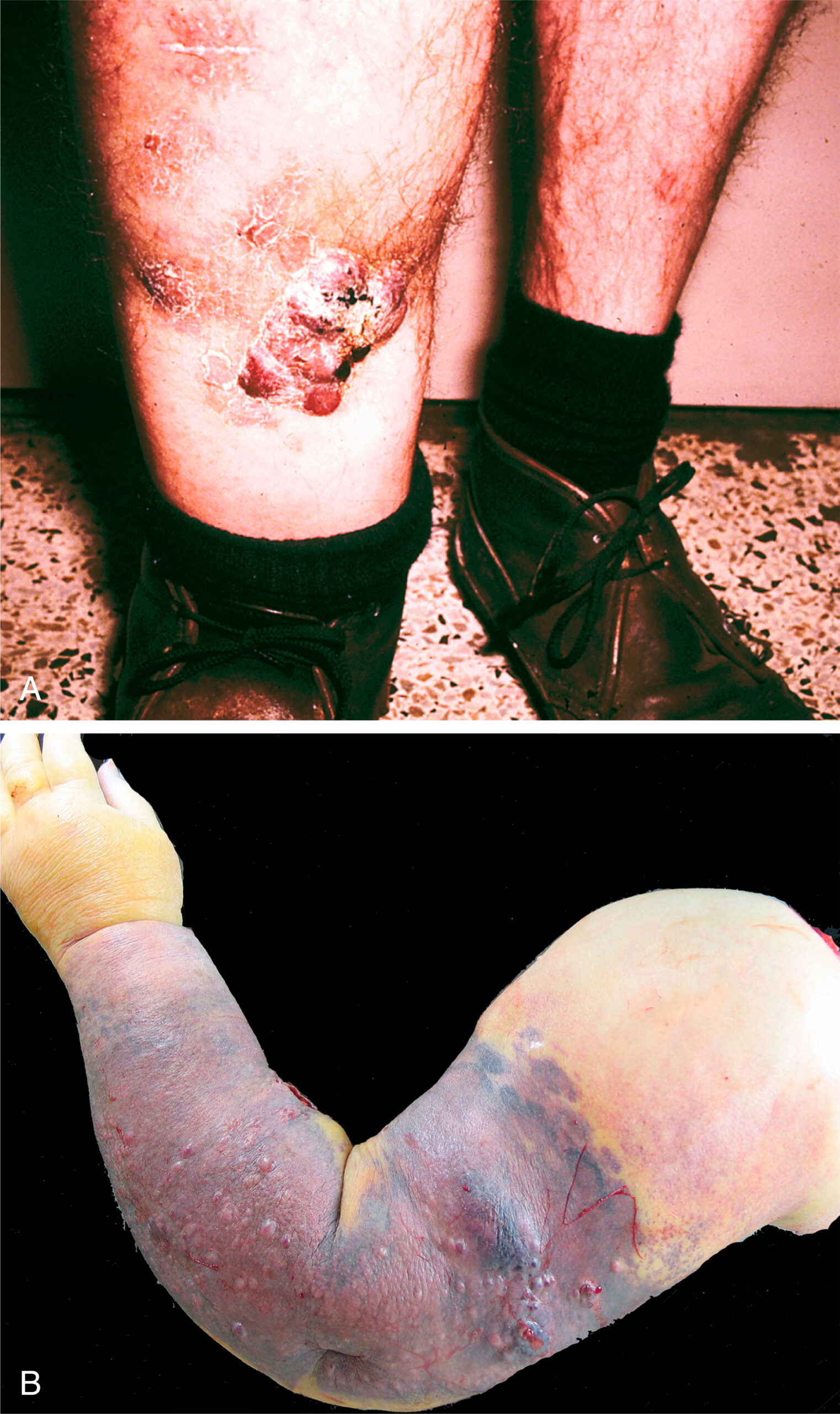 A panel of two clinical photos displays a swollen lower leg and arm with lesions, crust, and marks. Photo A shows two lower legs: one appears normal, while the other is inflamed with raised nodules and ulcerations on the shin. Photo B depicts a severely swollen upper arm with tense, dark skin areas covered in violaceous plaques and nodules.