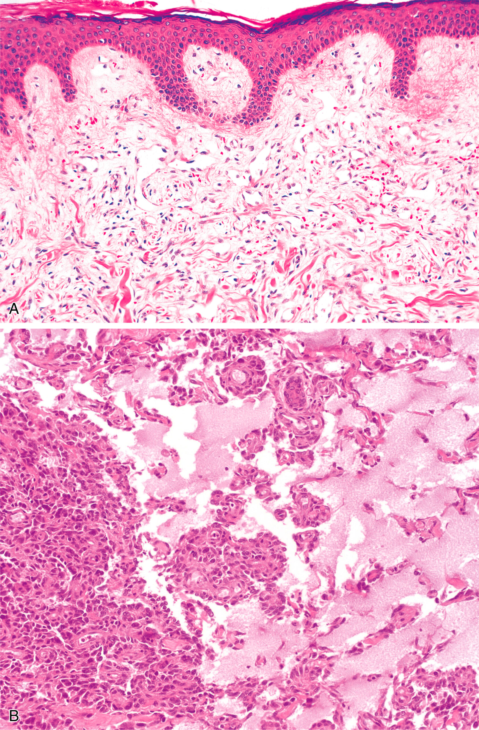 A section contains two panels, with the upper panel showing stratified epithelium and underlying connective tissue and the lower panel depicting solid nests and glandular structures. The upper panel shows stratified epithelium with surface undulations and underlying loose connective tissue. The epithelium consists of multiple cell layers with basophilic nuclei and an intact basal layer. The loose connective tissue contains small blood vessels, fibroblasts, and inflammatory cells. The lower panel displays a densely cellular region with solid nests of cells, hyperchromatic nuclei, and irregular arrangement. Adjacent glandular spaces with luminal contents are visible. The surrounding stroma is fibrous with occasional compressed structures, which highlight the contrast between cellular and glandular areas.