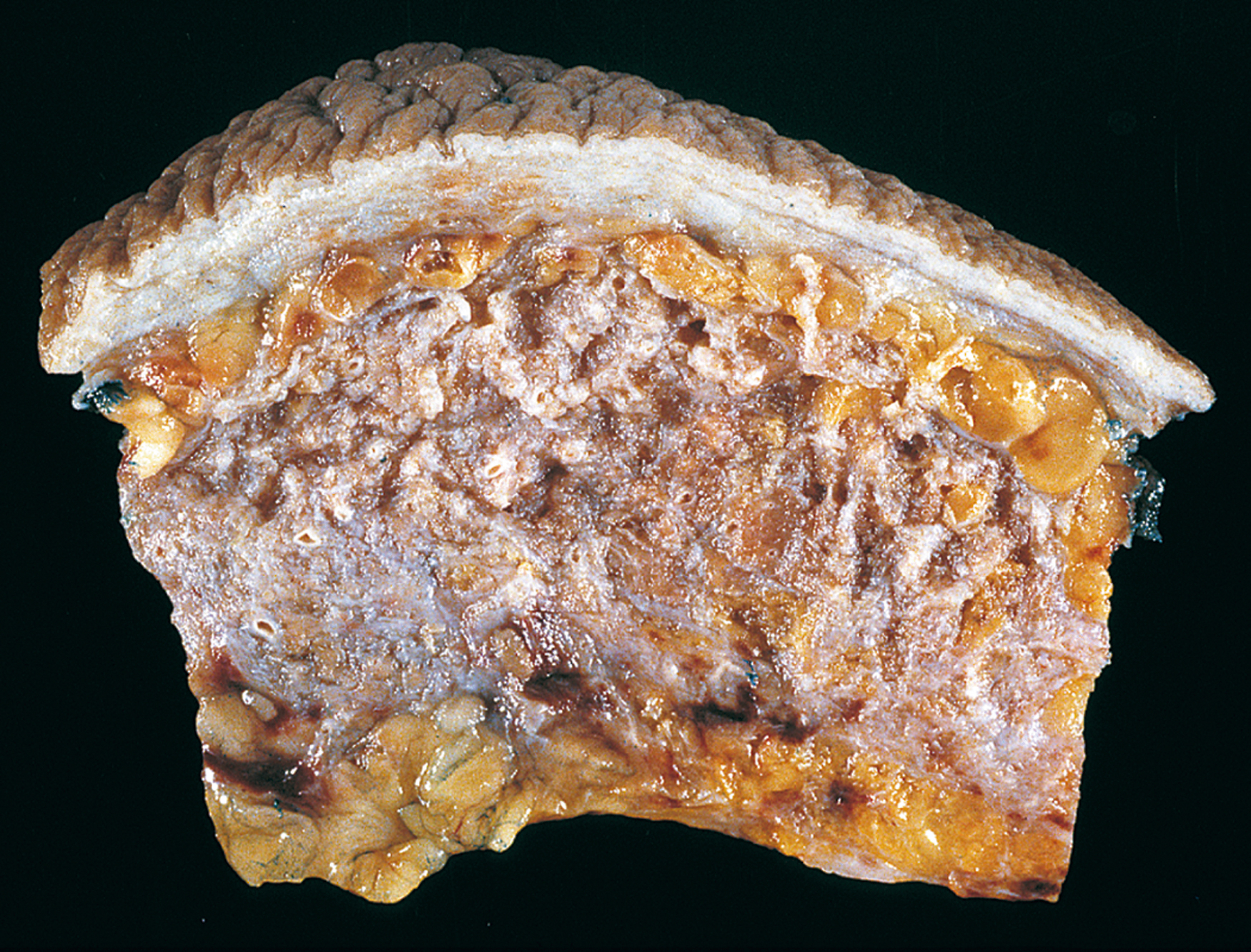 A cross-section of breast tissue contains a thickened fibrous area with irregular texture surrounded by adipose tissue and overlying skin.