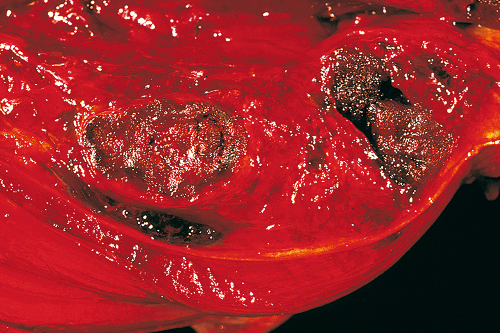 A longitudinal section of deep soft tissue contains two ulcerated lesions with irregular raised margins and necrotic bases.