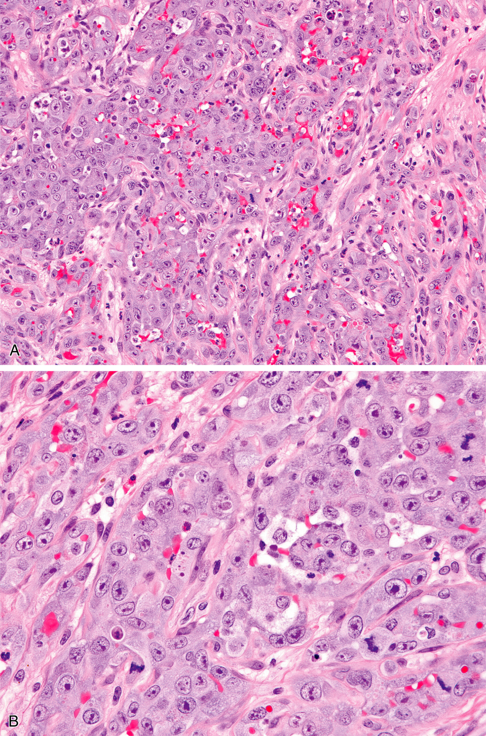 A histological section contains densely packed tumor cells with pleomorphic nuclei and prominent nucleoli in a fibrous stroma. The histological section contains densely packed tumor cells embedded in a fibrous stroma. The cells have pleomorphic nuclei, prominent nucleoli, and occasional mitotic figures. The cytoplasm of the tumor cells appears variable, and nuclear crowding is present. Inflammatory cells are scattered in the background. Vascular spaces are present between tumor cell clusters. The arrangement of cells lacks normal tissue architecture. The section is presented in two magnifications, with the lower panel displaying a higher magnification of the cellular features, including more distinct nuclear and nucleolar details.