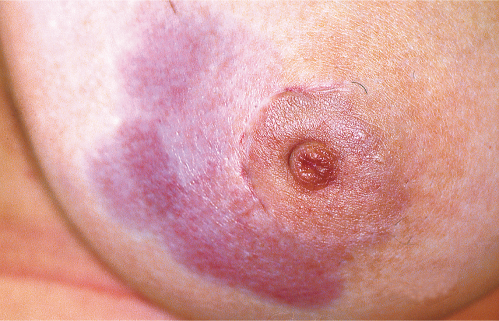 A breast with an irregular patch of discoloration involving the skin around the nipple after breast-conserving surgery and irradiation.