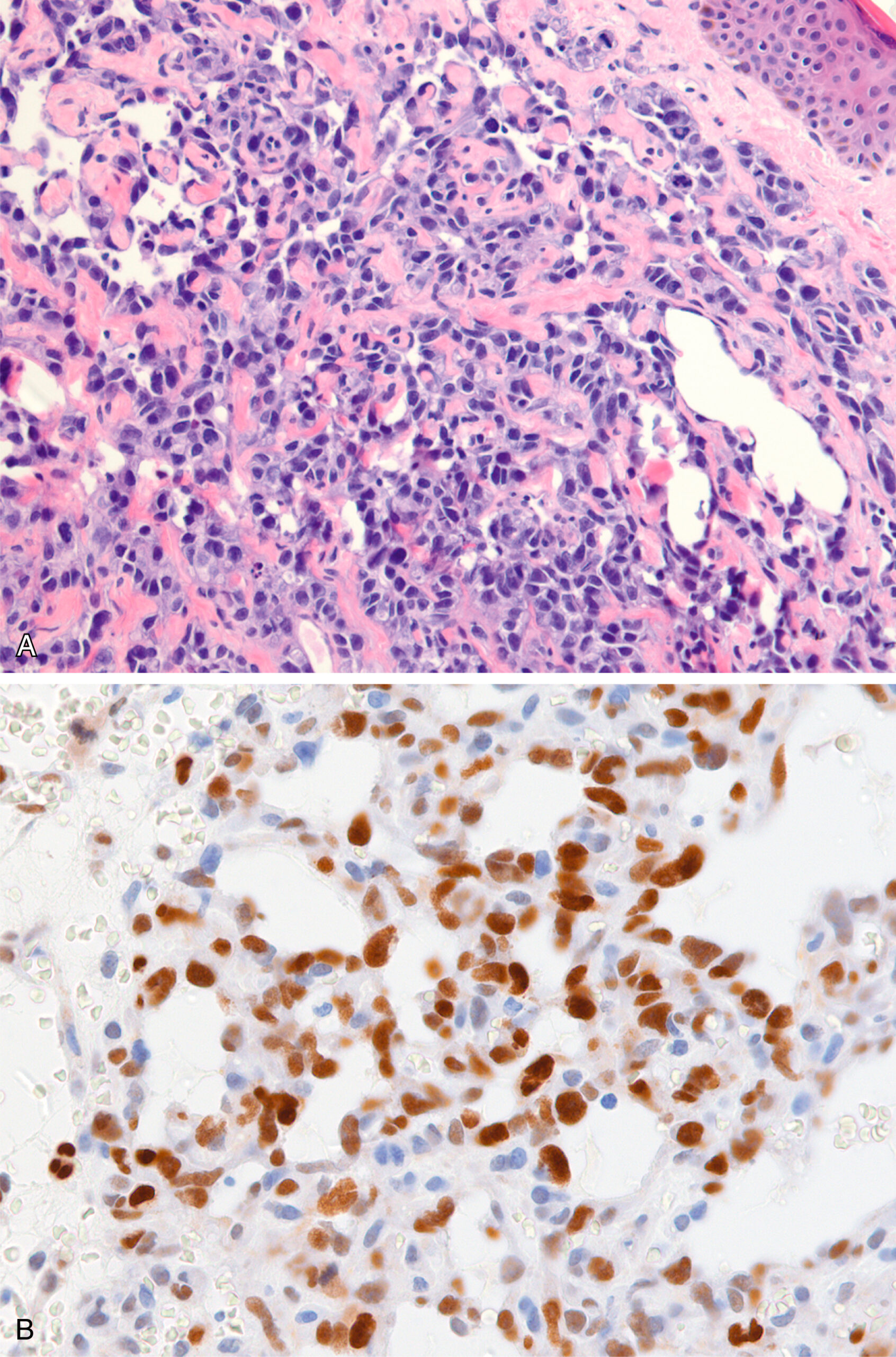 A histological section of tissue with clustered cells in the upper panel and scattered dark-stained nuclei among lighter cells in the lower panel. The upper panel displays a histological section of tissue with densely packed cells and irregular architecture. The cells vary in size and shape and are distributed unevenly throughout the tissue. A glandular structure with a visible lumen is present on the right side of the section. The lower panel depicts a separate histological section with multiple nuclei stained darkly and scattered among surrounding lightly stained cells. The nuclei appear round to oval in shape and are distributed throughout the field with no apparent structural pattern. The contrast in staining highlights cellular detail, including nuclear size, shape, and distribution.