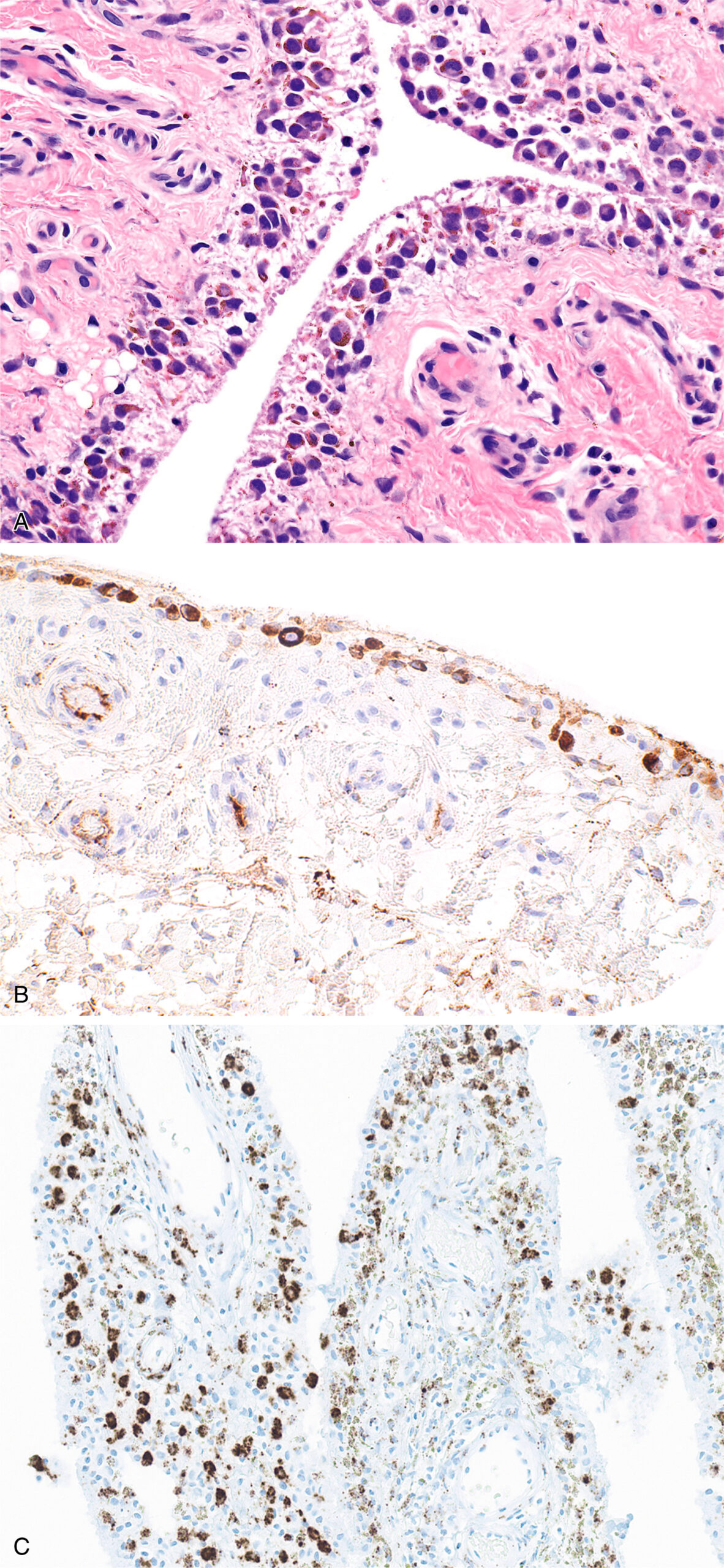 Three microscopic views of synovial tissue with proliferative changes, clusterin expression, and colony-stimulating factor one messenger ribonucleic acid signal. The composite image displays three vertically stacked micrographs of synovial tissue. Panel A shows a hematoxylin and eosin-stained section of non-neoplastic synovium from a patient with proliferative synovitis, revealing a dense cellular infiltrate where synoviocytes appear as large, plasmacytoid mononuclear cells characterized by their prominent nuclei and abundant cytoplasm, some containing visible intracytoplasmic iron deposits that appear as granular pigment. Panel B presents an immunohistochemical stain for clusterin, highlighting the expression of this protein within both normal and neoplastic synoviocytes as indicated by the brown chromogen staining localized primarily to the cellular membranes and cytoplasm. Panel C displays an in situ hybridization assay detecting C S F 1 m R N A, with the numerous dark brown punctate signals indicating abundant expression of this messenger R N A within the synoviocytes, demonstrating transcriptional activity for this cytokine in both normal and proliferative synovial tissue.