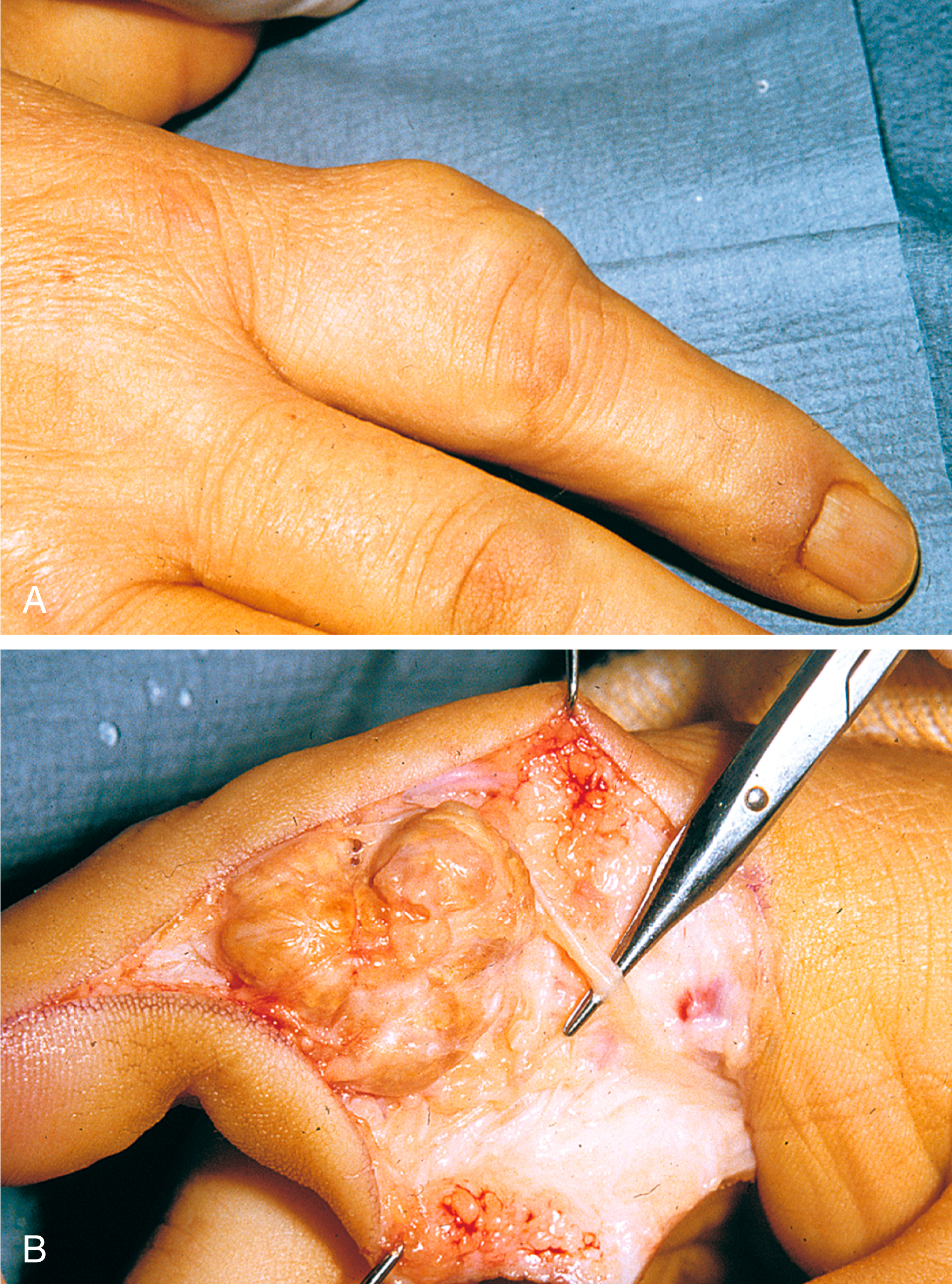 Two photos labeled A and B show a finger with a localized mass at the proximal portion and an exposed mass adjacent to the tendon during a surgical procedure.