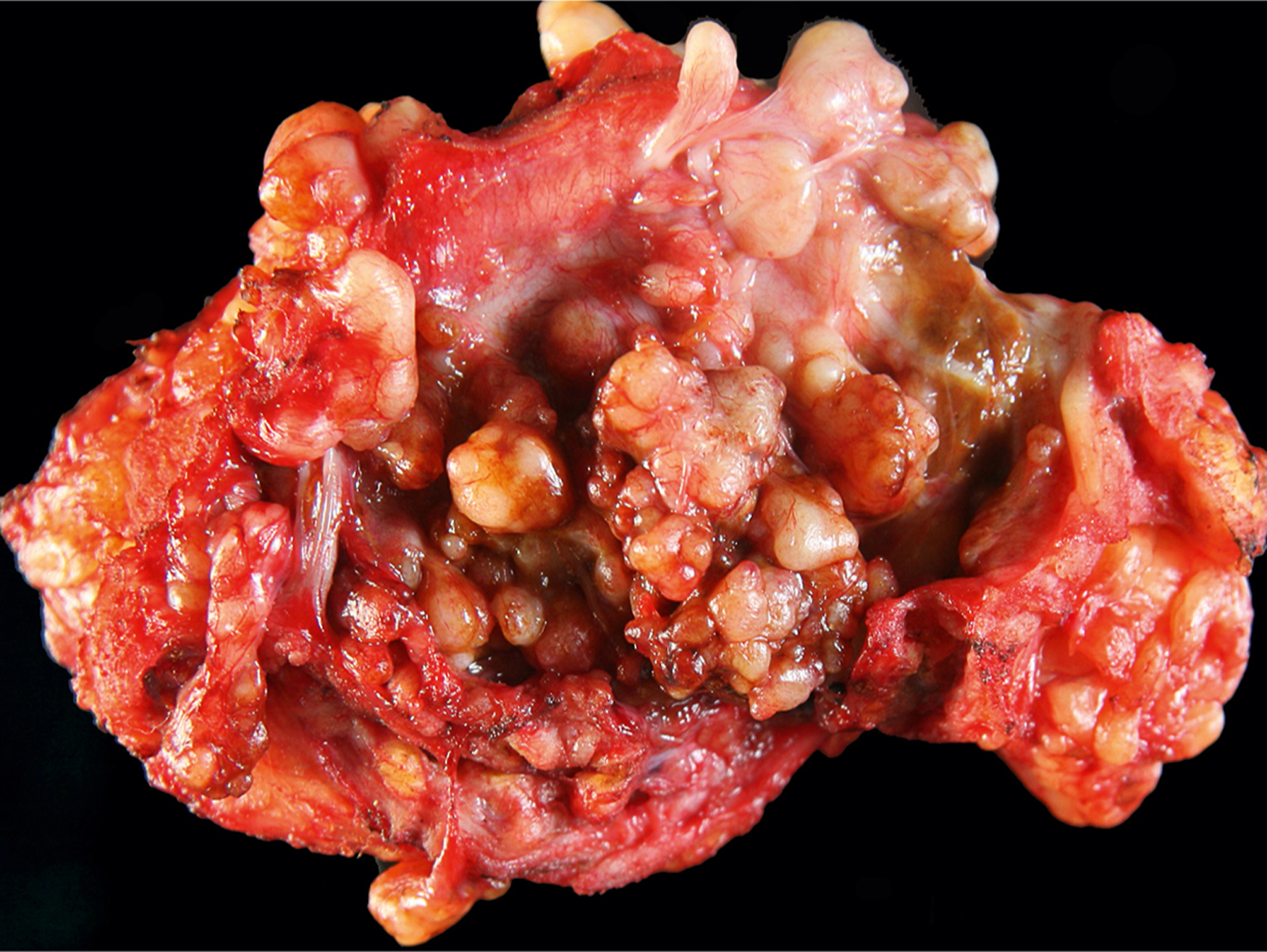 A gross specimen of intra-articular mass with multinodular surface and irregular projections from the knee joint.