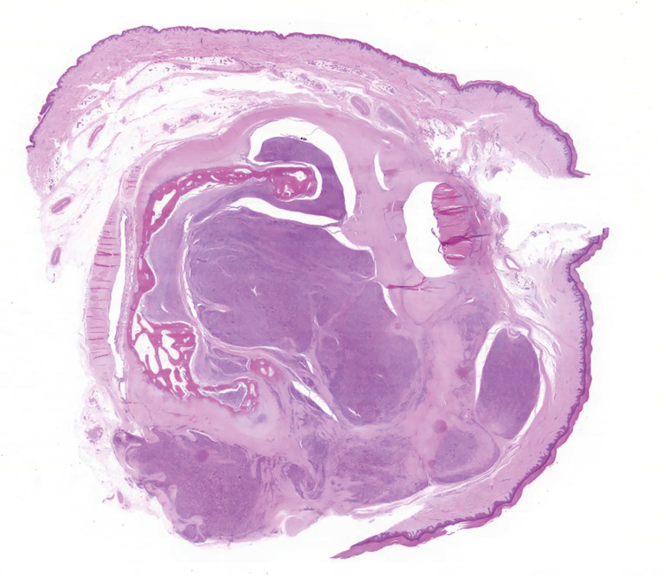 A histological section of a toe mass with a well-circumscribed lesion invading adjacent skin and bone tissue.
