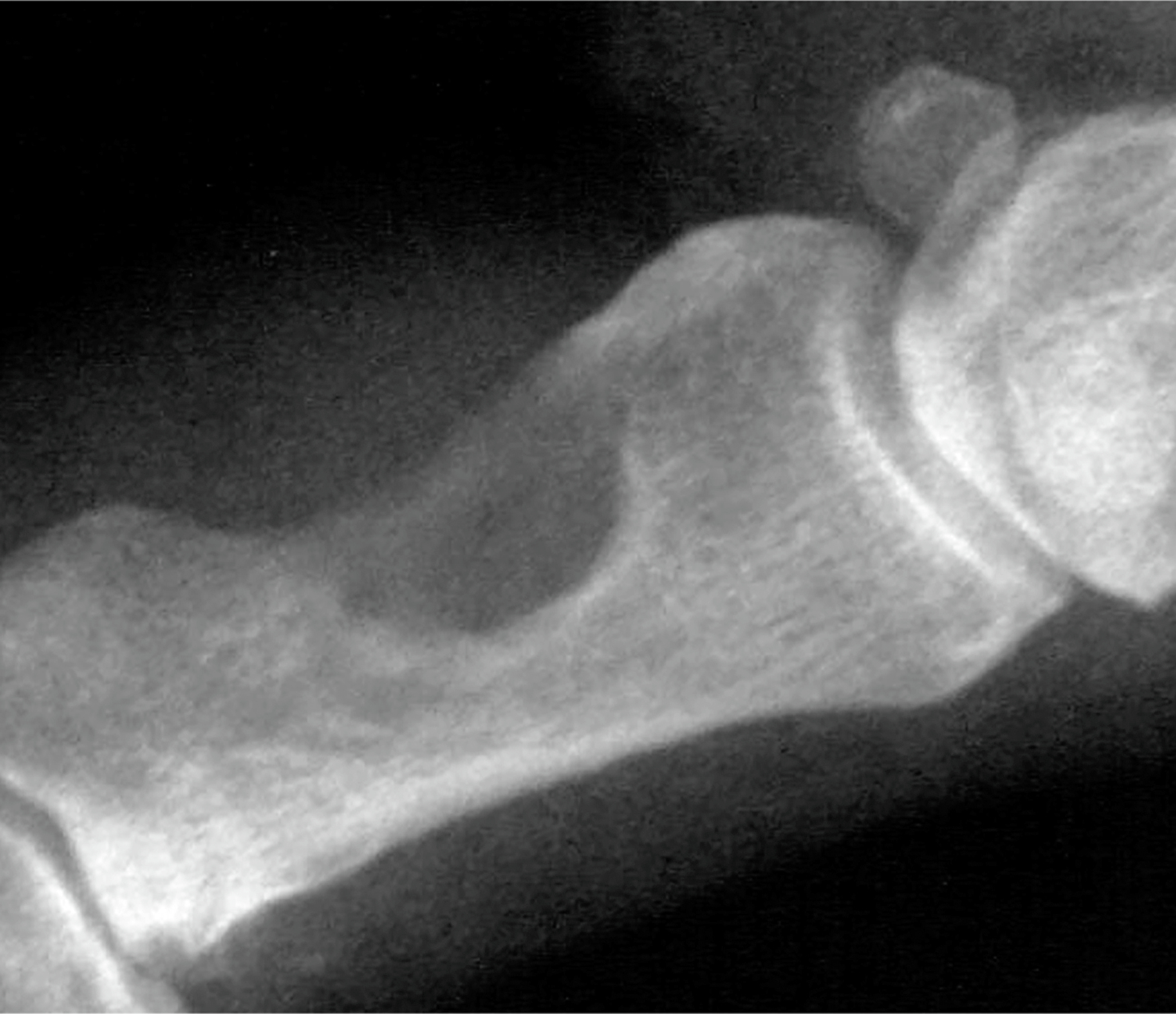A radiograph of a finger phalanx with a well-defined lytic lesion consistent with localized tenosynovial giant cell tumor erosion.